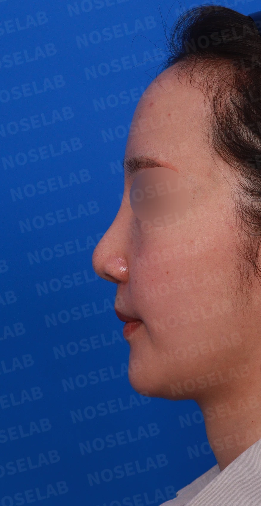 양악수술 뒤 코가 퍼져 보이고 코끝이 처지는 이유, 늑연골 재건 방법 — 디자인 상담 정면 , 비스듬한 측면 , 측면 사진입니다.