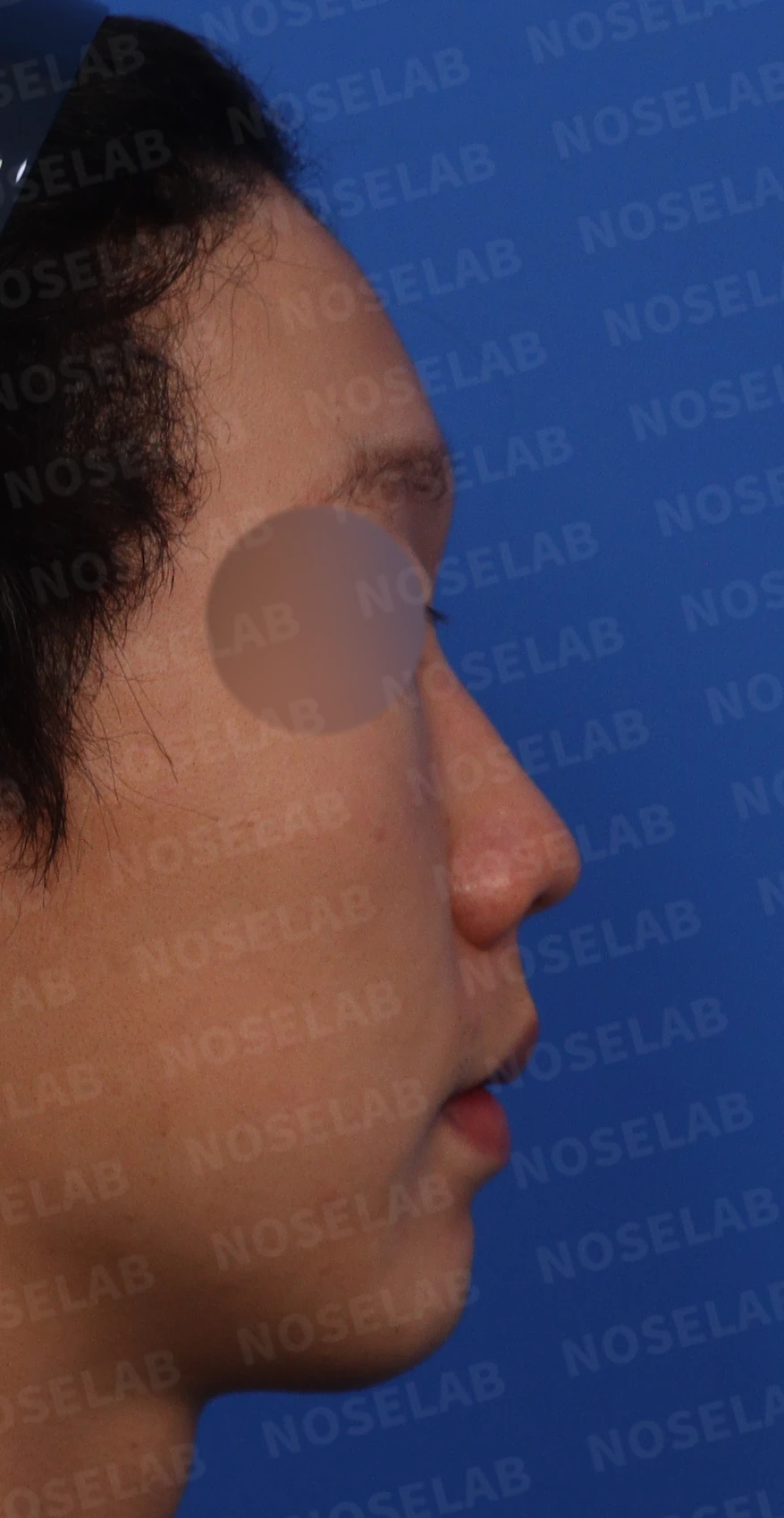들린코, 작은코, 비순각 교정 사례 - 기능과 미용을 동시에 잡다 — 수술전 디자인 상담 우측 측면, 비스듬한 측면, 콧구멍 사진입니다.