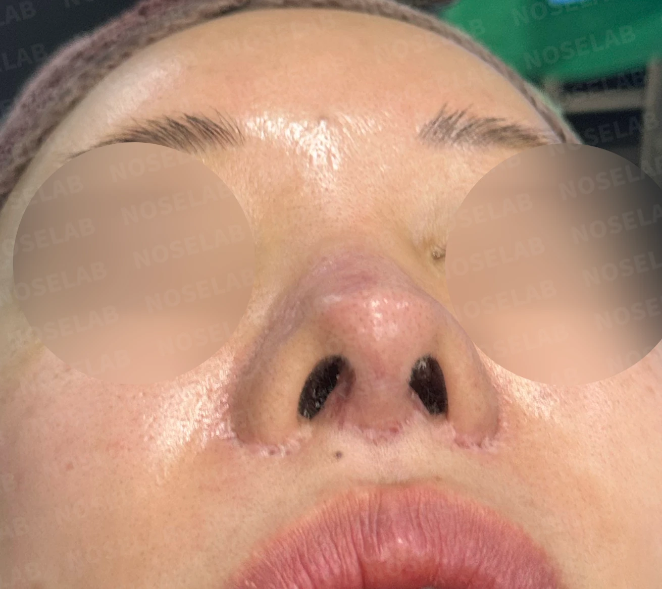 코 수술 뒤 콧등 피부가 괴사하면 어떤 변화가 남고, 재건은 어떻게 하나 — 수술 전 / 수술 직후 0일 직후 사진은 부기가 있는 상태로 최종 결과와 다를 수 있습니다.