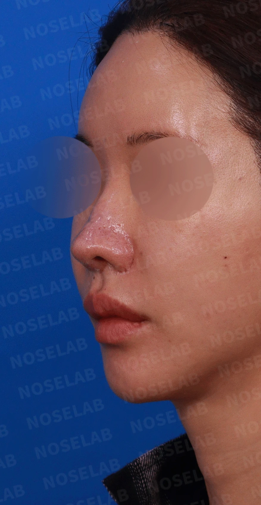 코 수술 뒤 콧등 피부가 괴사하면 어떤 변화가 남고, 재건은 어떻게 하나 — 디자인 상담 비스듬한 측면 , 좌측 측면, 비공 사진