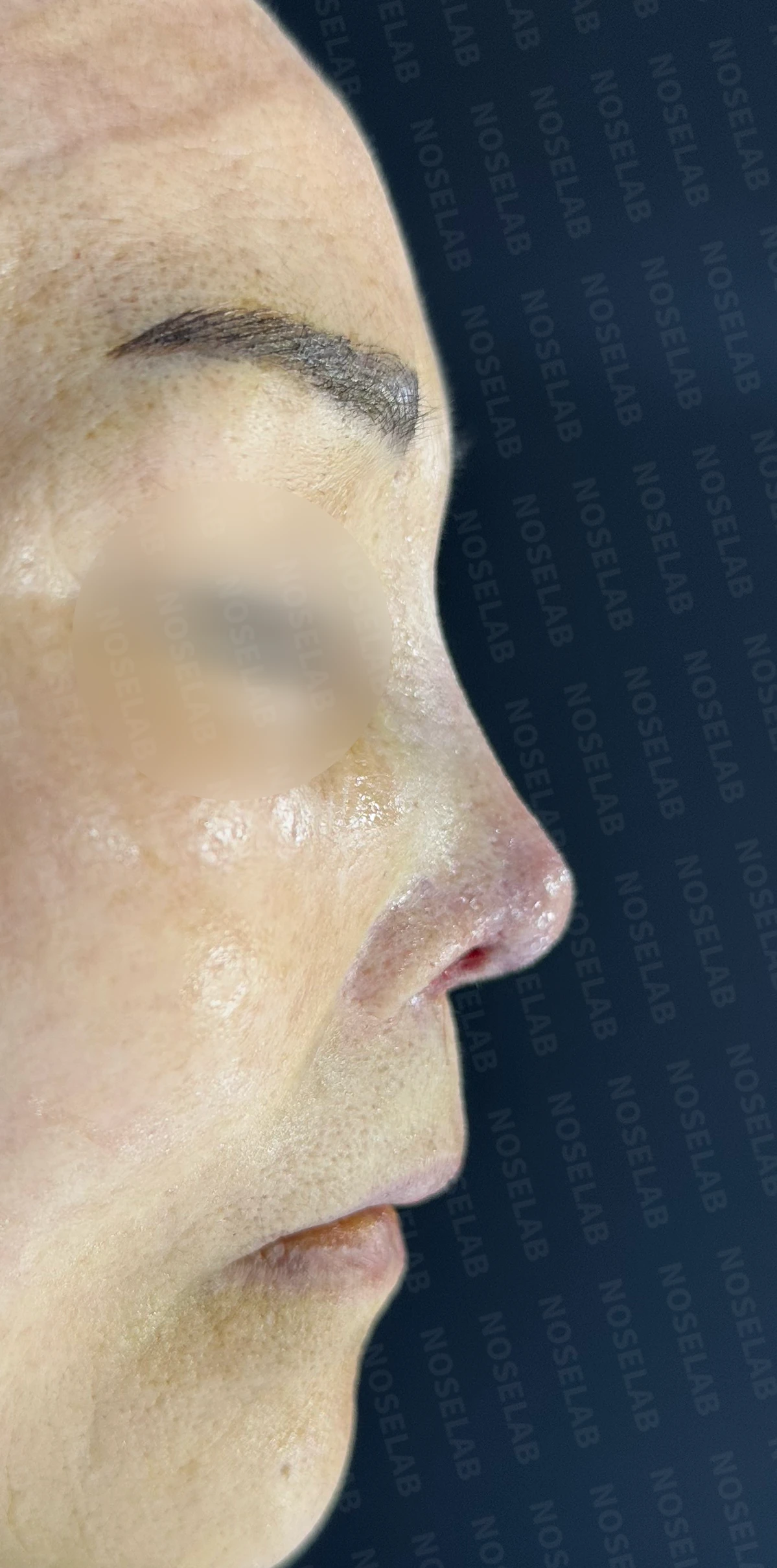 비중격 천공이 있는 코의 재수술 계획 — 수술 직후 0일 정면, 측면, 비스듬한 측면 직후 사진은 부기가 있는 상태로 최종 결과와 다를 수 있습니다.
