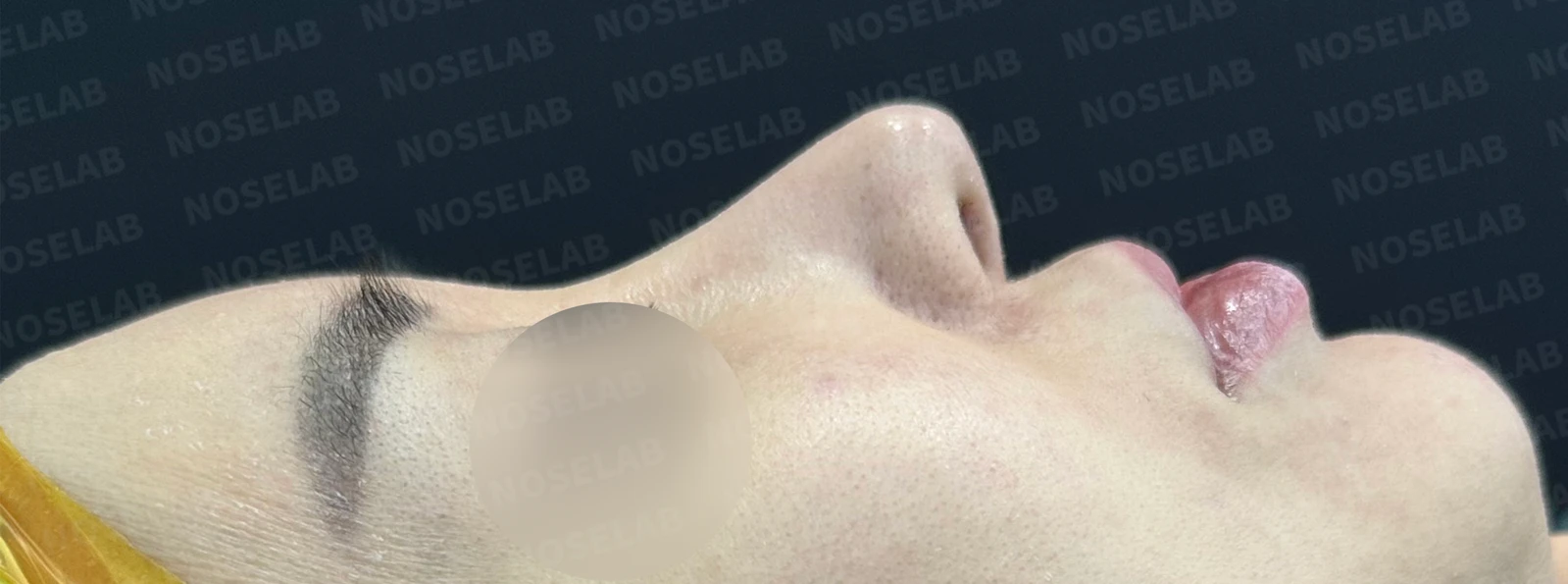 긴코 교정은 어떻게 할까요? — 수술 전 / 수술 직후 0일 직후 사진은 부기가 있는 상태로 최종 결과와 다를 수 있습니다.