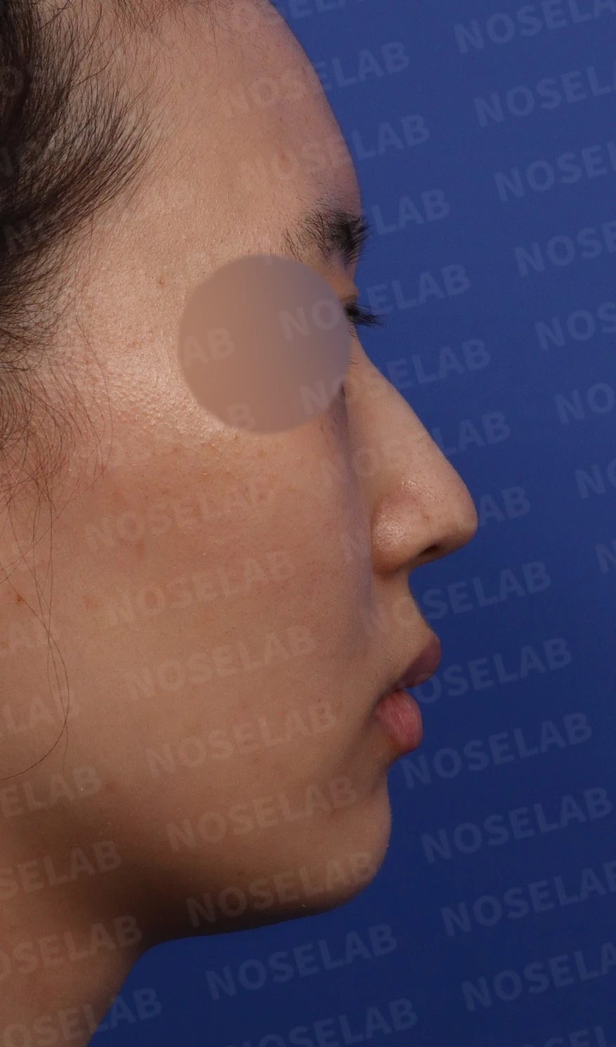 매부리코에 코의 휨과 비공 비대칭이 함께 오는 이유, 비중격 연골 교정은 어떻게 하나 — 디자인 상담 우측 비스듬한 측면, 측면, 비공 사진