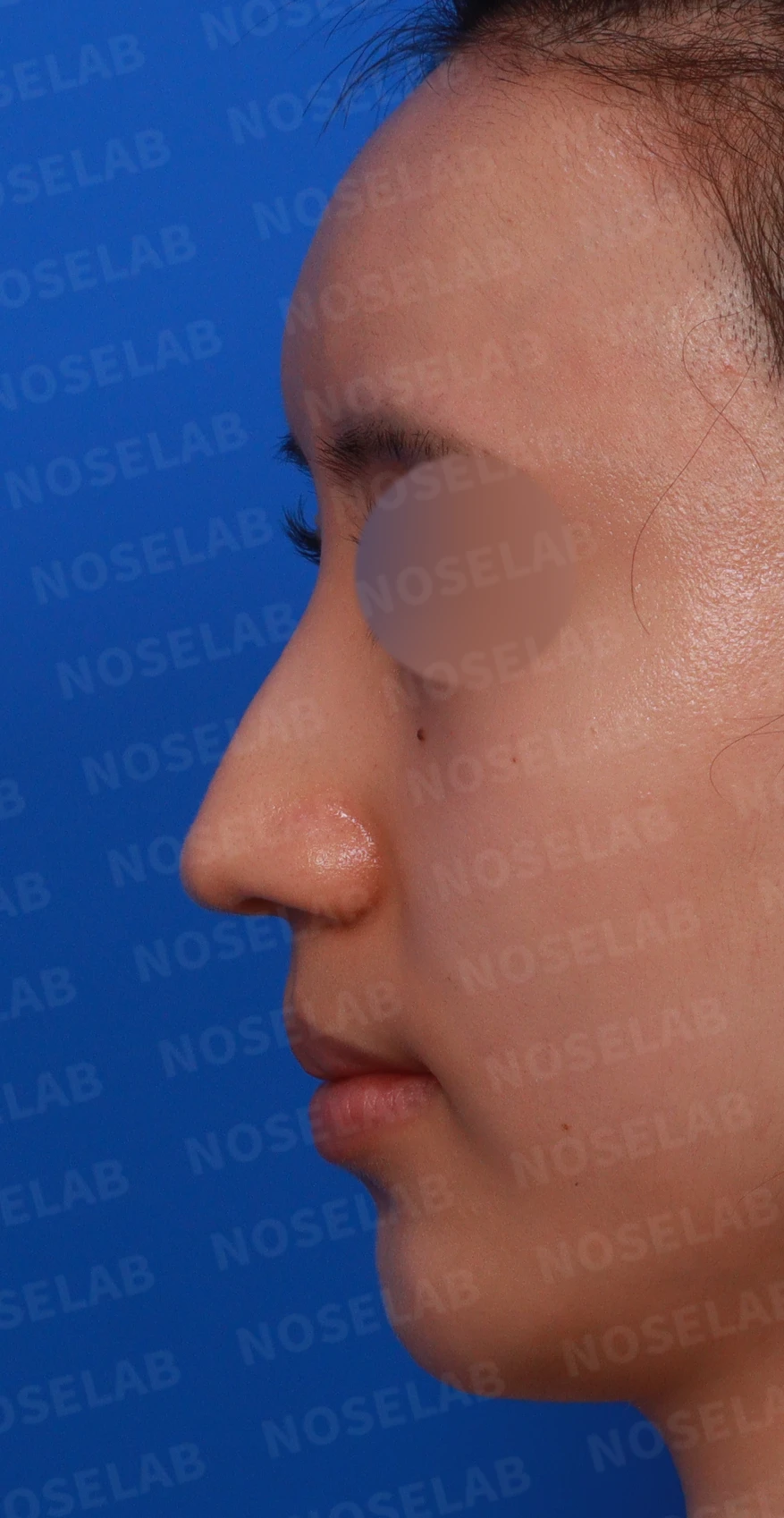 매부리코와 긴 코에 코막힘이 겹치는 이유, 교정은 어떻게 하나 — 디자인 상담 정면, 좌측 측면, 비스듬한 측면 사진입니다.