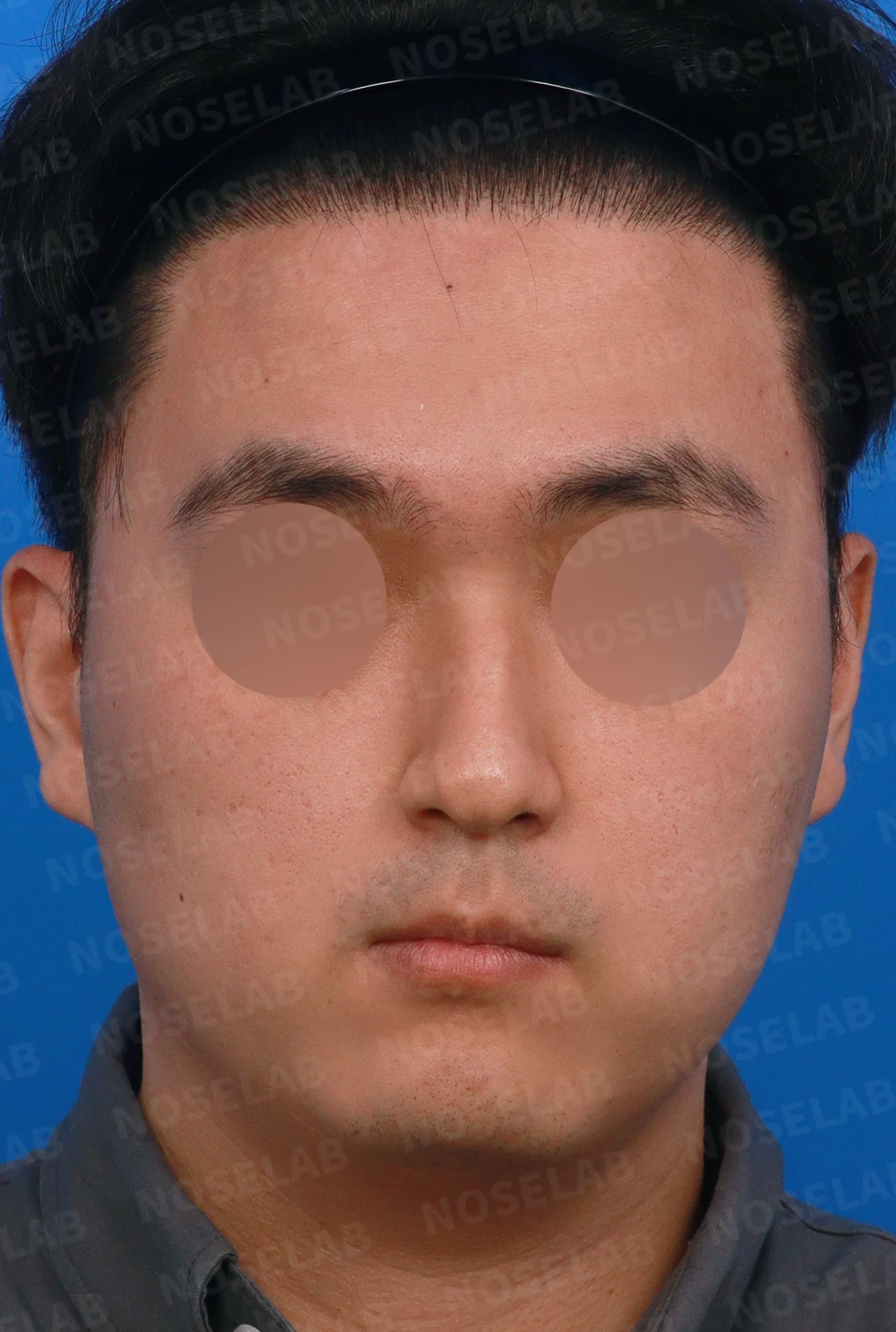 비중격이 휘면 코막힘과 휜 코가 함께 생기는 이유, 재건은 어떻게 하나 — 디자인 상담 정면, 좌측 측면, 비스듬한 측면 사진입니다.