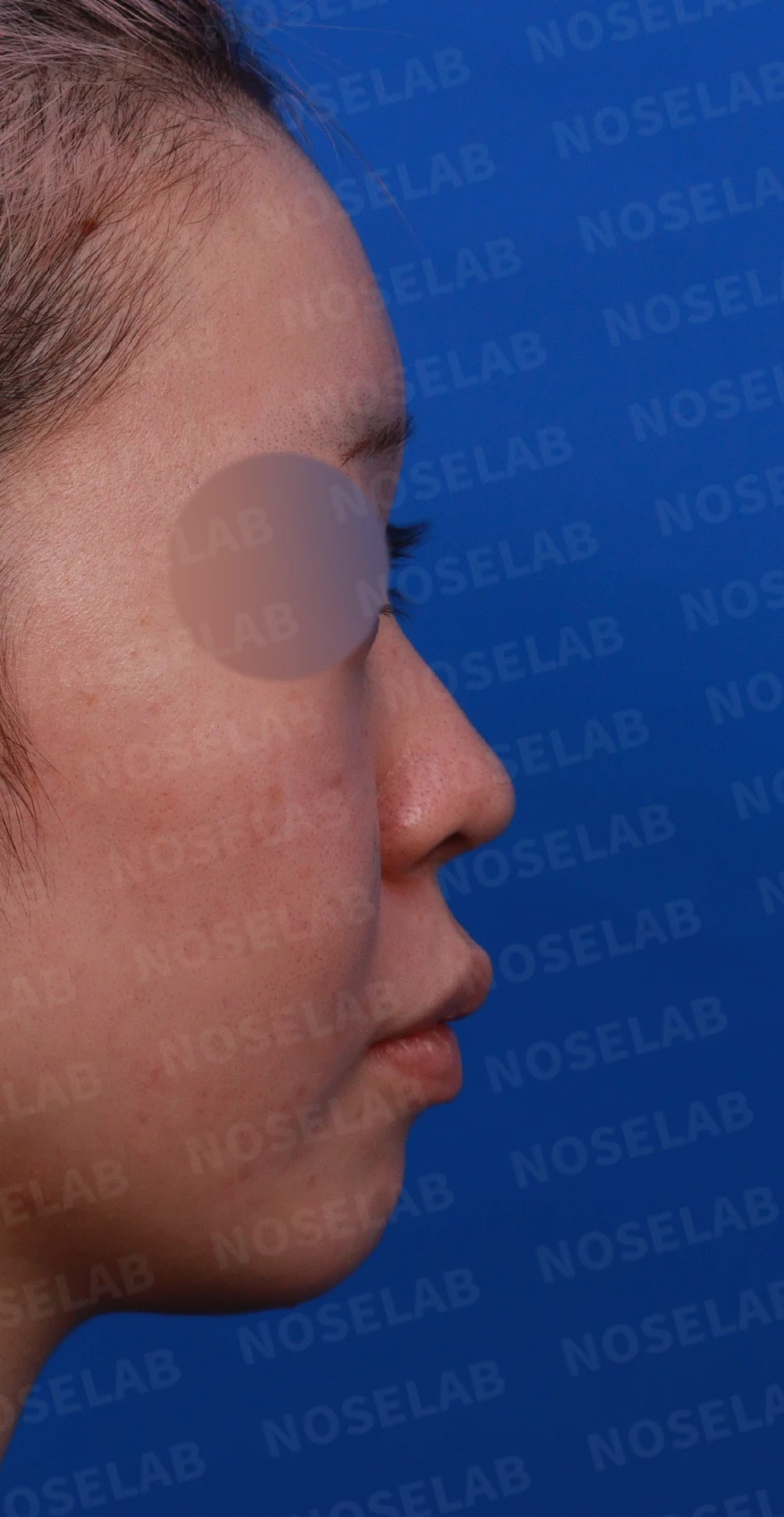 퍼진코, 복코 교정으로 균형 잡힌 이미지 완성 — 디자인 상담 정면, 우측 비스듬한 측면, 측면 사진입니다.