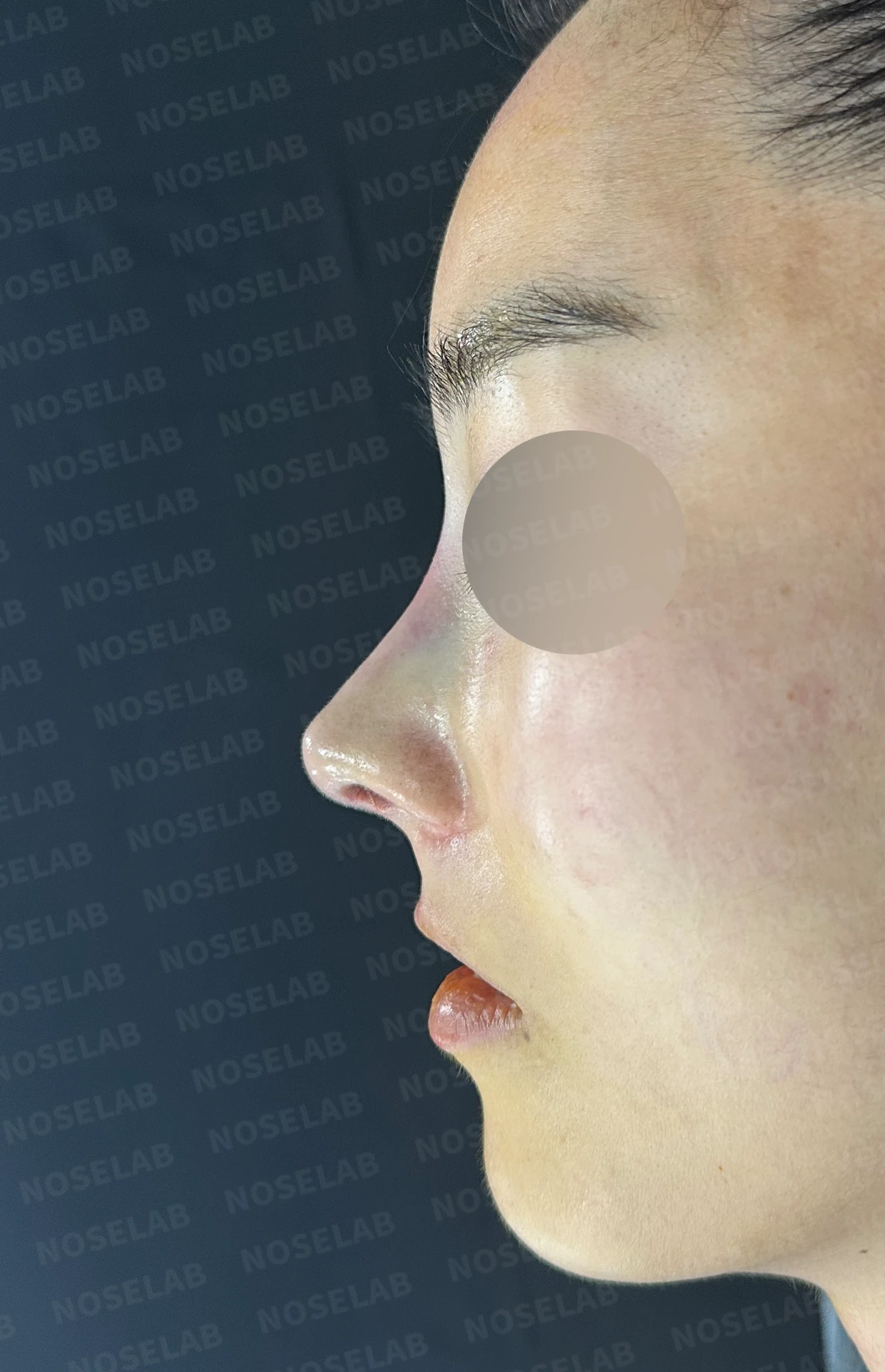여러 차례 받은 코필러가 남긴 퍼진 코와 코막힘, 어떻게 정리하나 — 수술 직후 0일 정면, 측면, 비스듬한 측면 사진 직후 사진은 부기가 있는 상태로 최종 결과와 다를 수 있습니다.