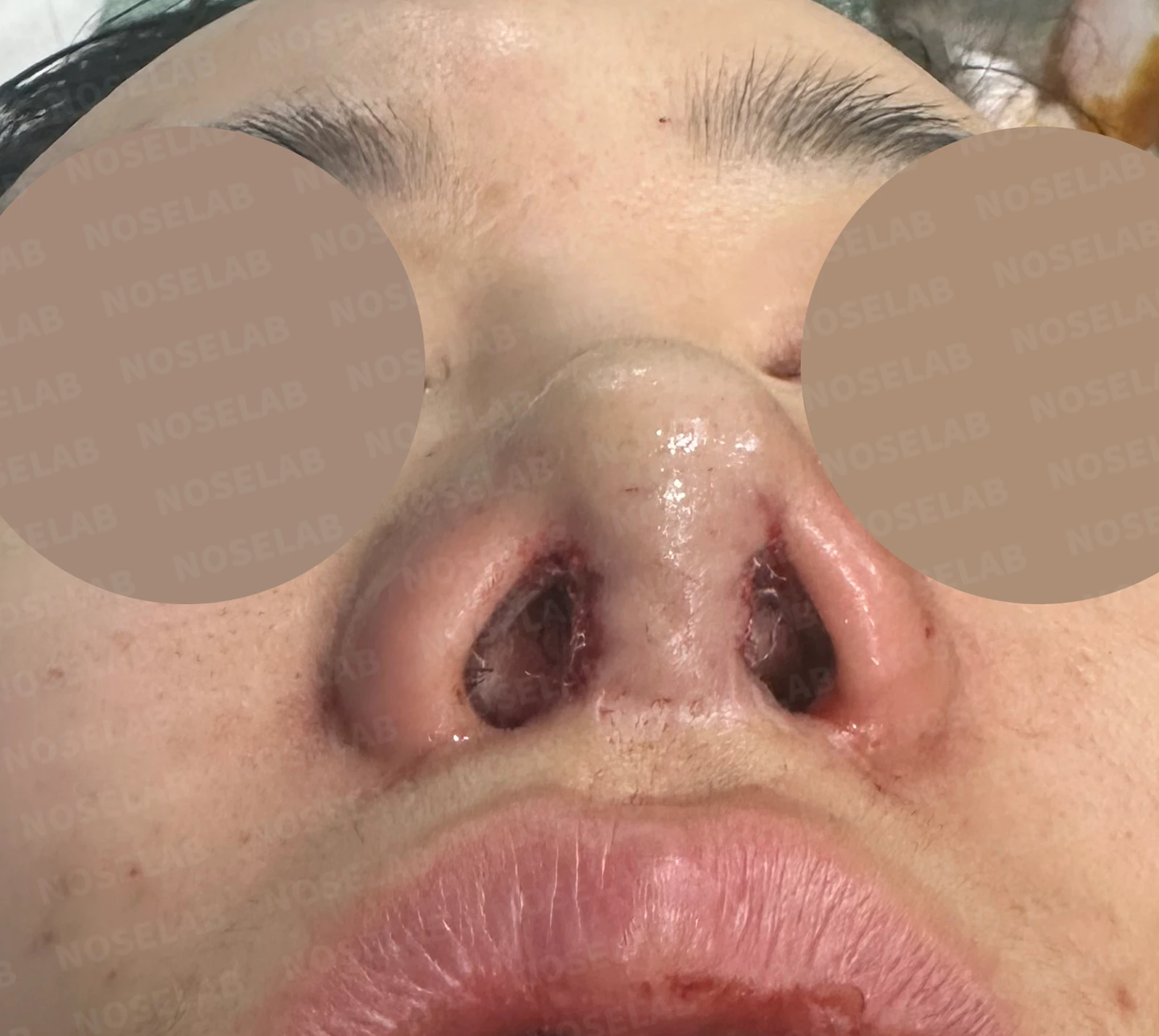 휜코, 뭉툭하고 처진코 수술 사례_대표원장 강차영 — 수술전(좌) 수술직후(우)