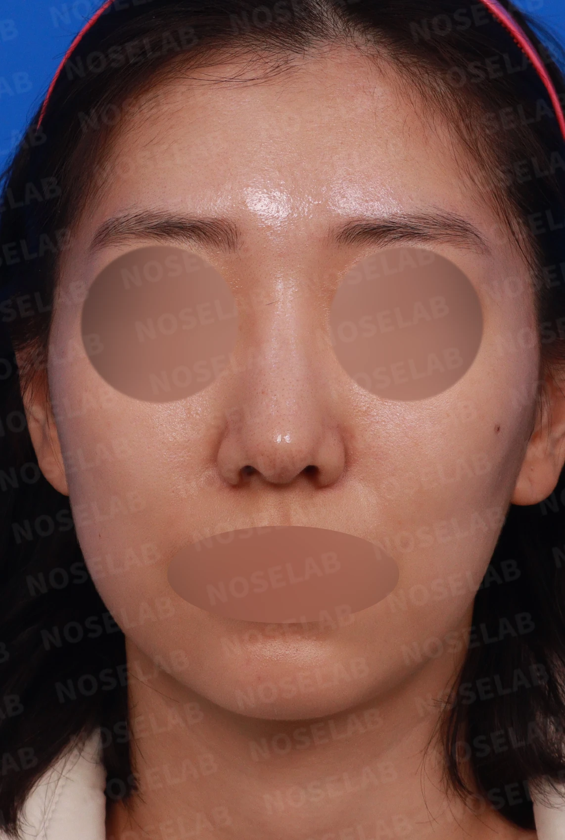 매부리를 정리한 뒤 콧등이 눌려 보이고 코끝이 뭉툭해지는 이유, 보형물 없이 교정하는 방법 — 디자인 상담 정면, 좌측 측면, 비스듬한 측면 사진