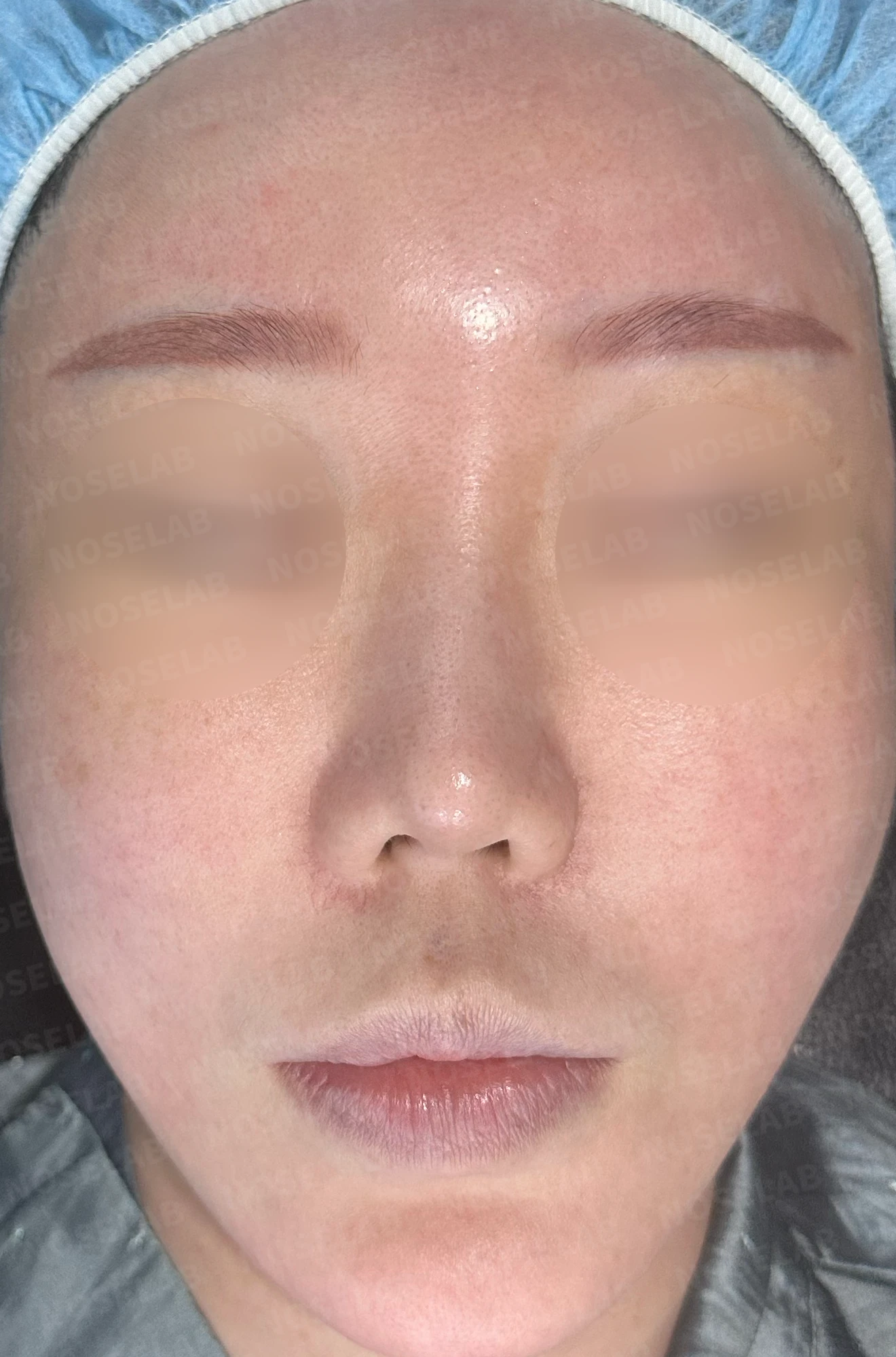 비주 함몰과 복코, 비공 비대칭의 교정 방법 — 수술 전 / 수술 직후 0일 직후 사진은 부기가 있는 상태로 최종 결과와 다를 수 있습니다.