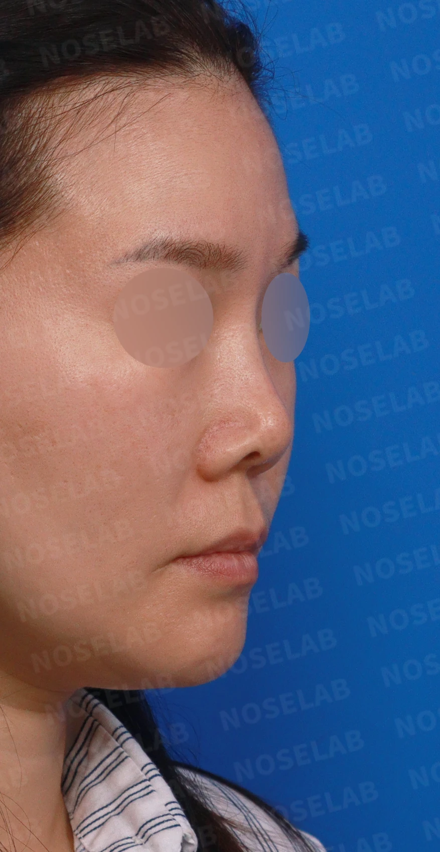 오래된 코성형 뒤 코끝이 들리고 콧구멍이 드러나는 이유, 제거와 자가진피 재건은 어떻게 하나 — 디자인 상담 우측 측면, 비스듬한 측면, 비공 사진