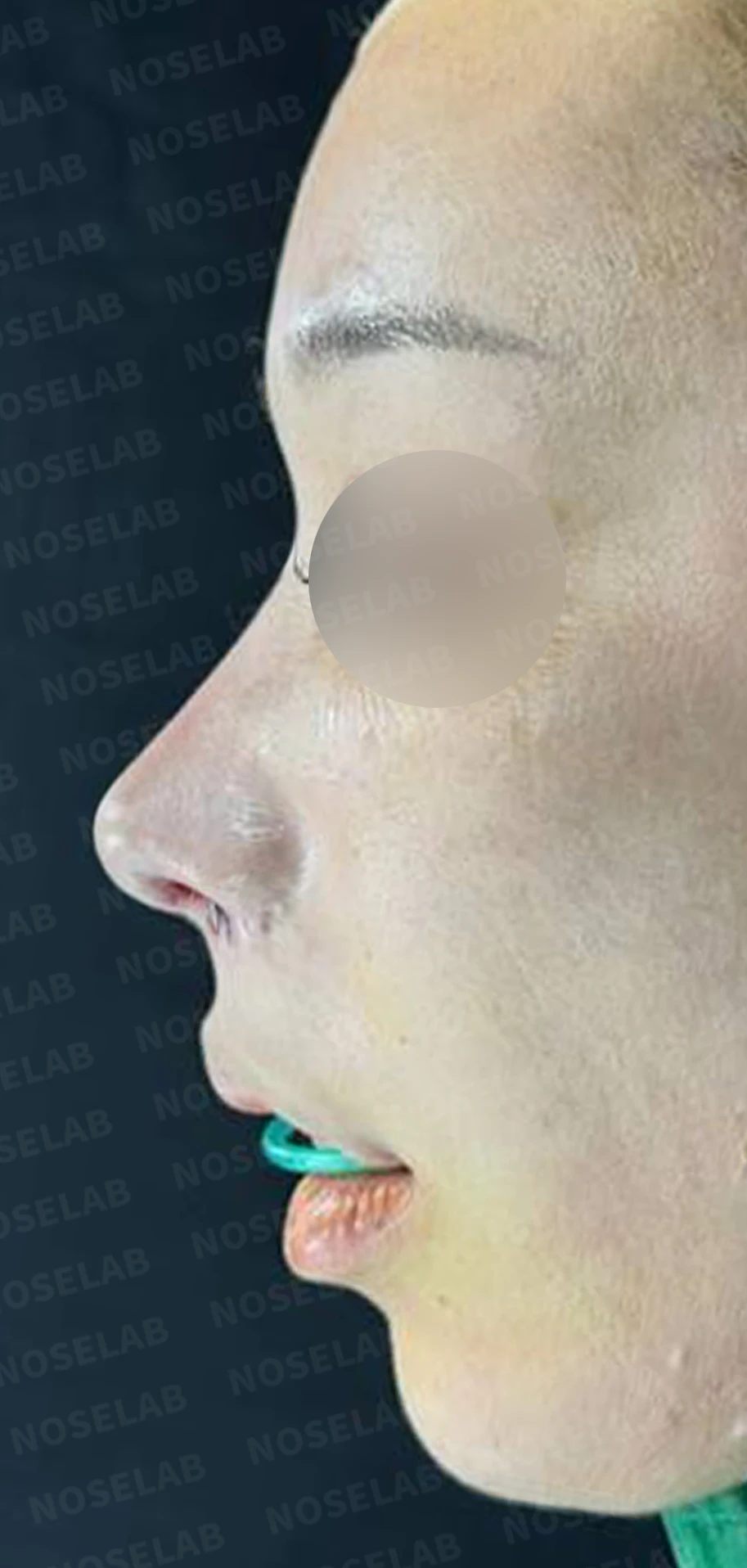 콧구멍 비대칭과 협착이 생기는 이유, 늑연골 재건과 Z성형은 어떻게 하나 — 수술 직후 0일 정면, 비스듬한 측면, 측면 사진입니다. 직후 사진은 부기가 있는 상태로 최종 결과와 다를 수 있습니다.