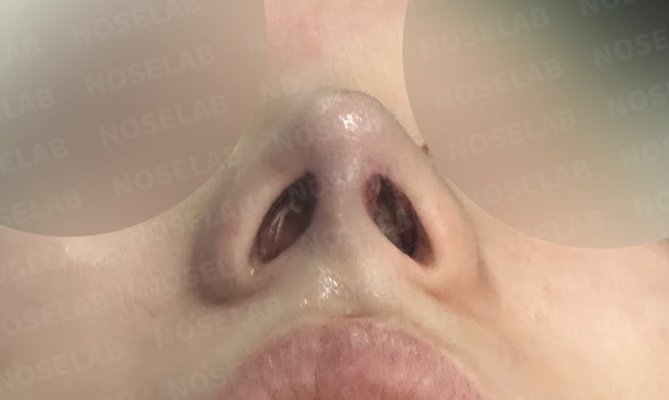 복코와 주먹코, 자가늑연골로 얄쌍하고 여성스러운 코 완성 — 수술직후 비공 사진입니다.