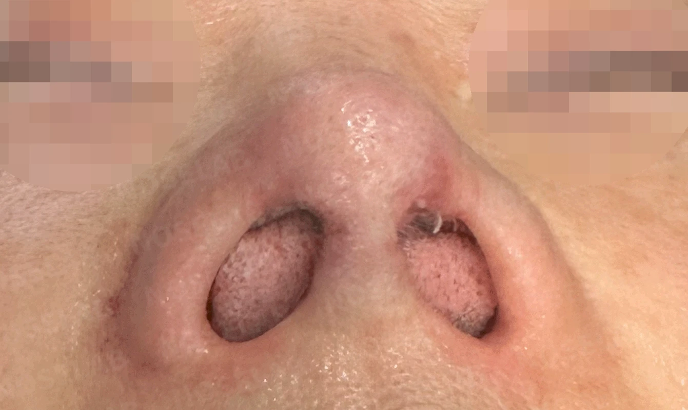 코가 짧고 들리며 비주가 함몰되는 이유, 자가 늑연골 재건은 어떻게 하나 — 본문 사진 15