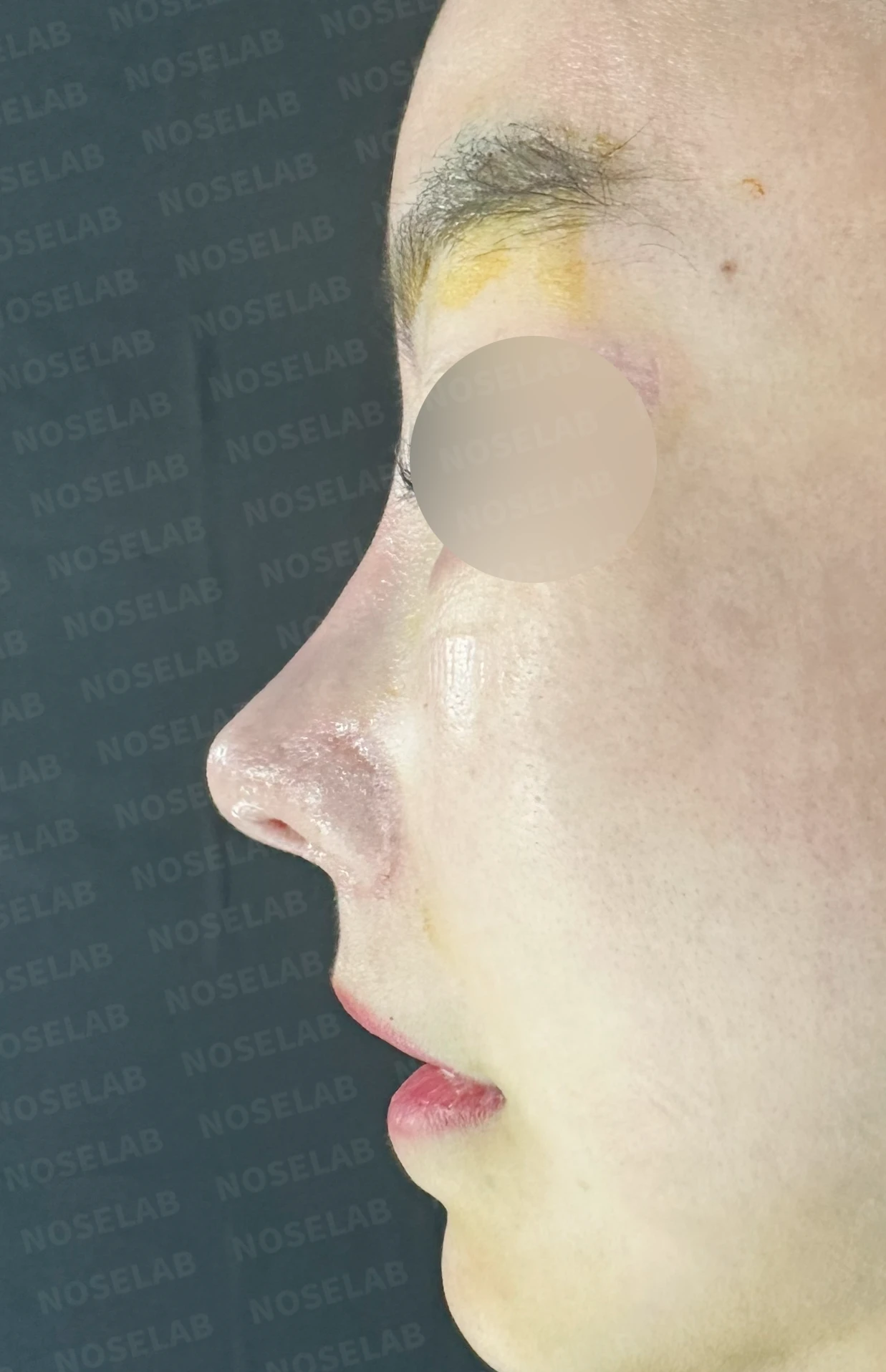 이식한 진피가 반복해서 흡수되는 이유, 재건은 어떻게 하나 — 수술 직후 0일 정면, 측면, 비스듬한 측면 사진입니다. 직후 사진은 부기가 있는 상태로 최종 결과와 다를 수 있습니다.