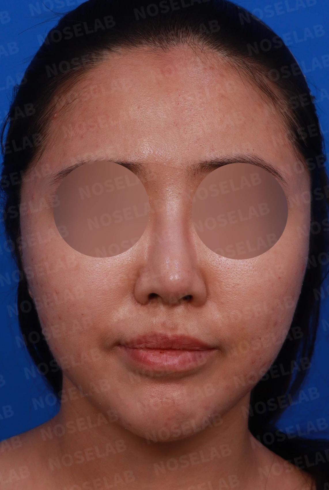 코필러 제거, 코막힘 해결 사례 — 디자인 상담 정면, 좌측 측면, 비스듬한 측면 사진