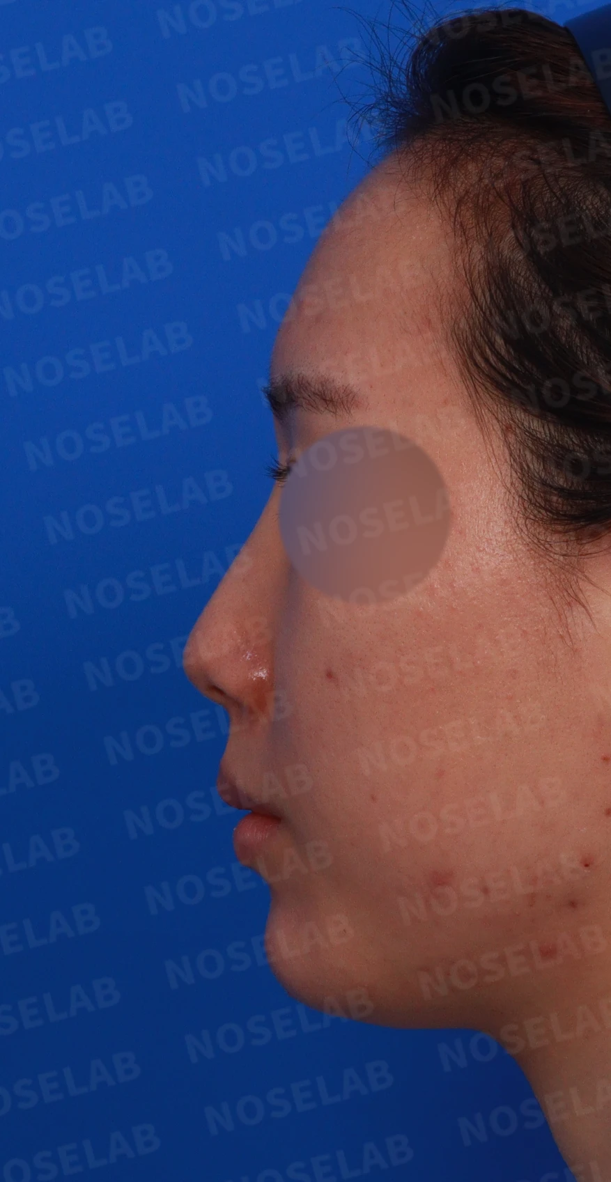 코 필러 뒤에도 휜 코와 코막힘이 남는 이유, 교정은 어떻게 하나 — 디자인 상담 정면, 좌측 측면, 비스듬한 측면 사진