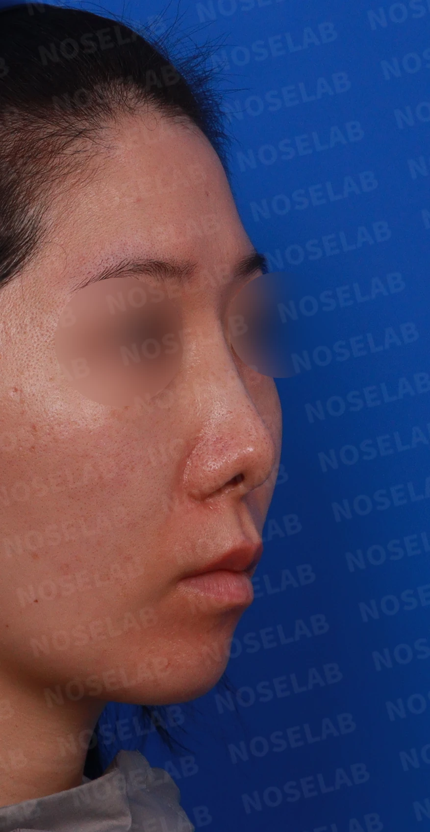 콧대 시작점이 높고 코가 휘어 보이는 이유, 자가 늑연골 교정은 어떻게 하나 — 디자인 상담 우측 측면 , 비스듬한 측면 , 비공 사진입니다.