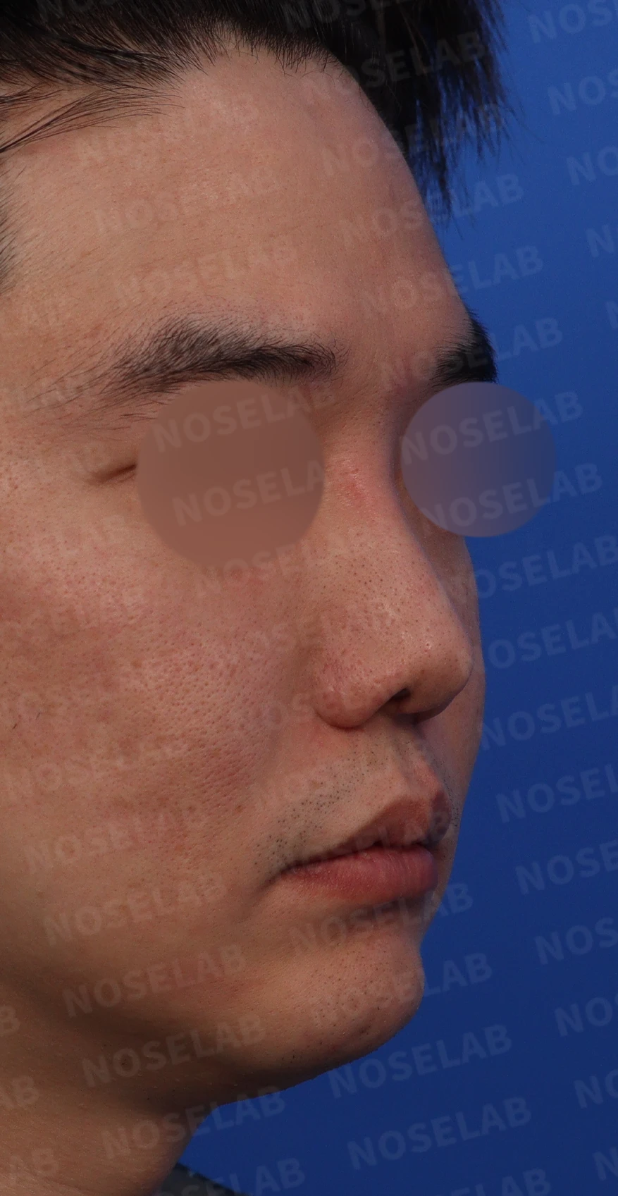 휜코와 콧구멍 비대칭을 함께 교정하는 방법 — 디자인 상담 사진 비공, 우측 비스듬한 측면, 측면
