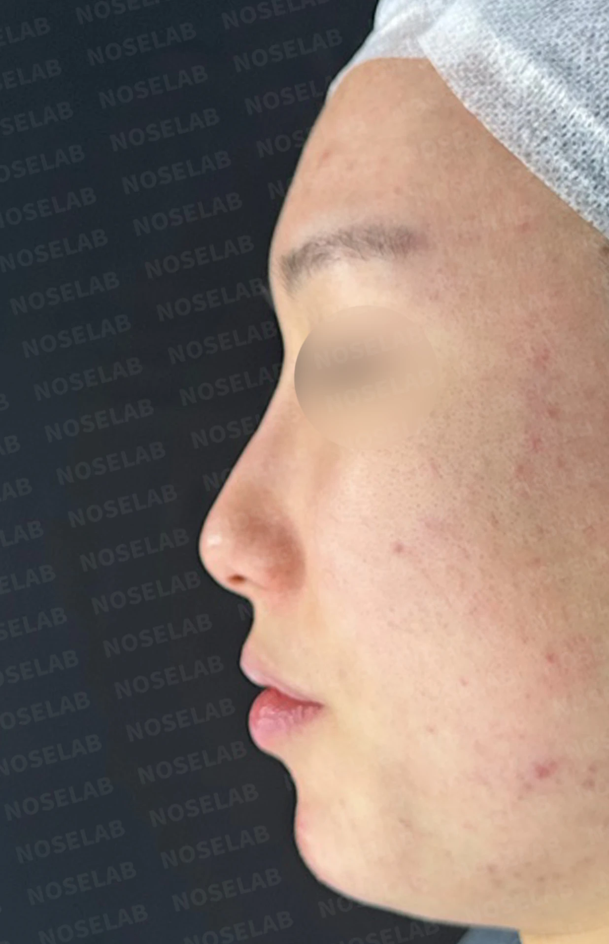 코 필러 뒤에도 휜 코와 코막힘이 남는 이유, 교정은 어떻게 하나 — 수술 전 / 수술 직후 0일 직후 사진은 부기가 있는 상태로 최종 결과와 다를 수 있습니다.