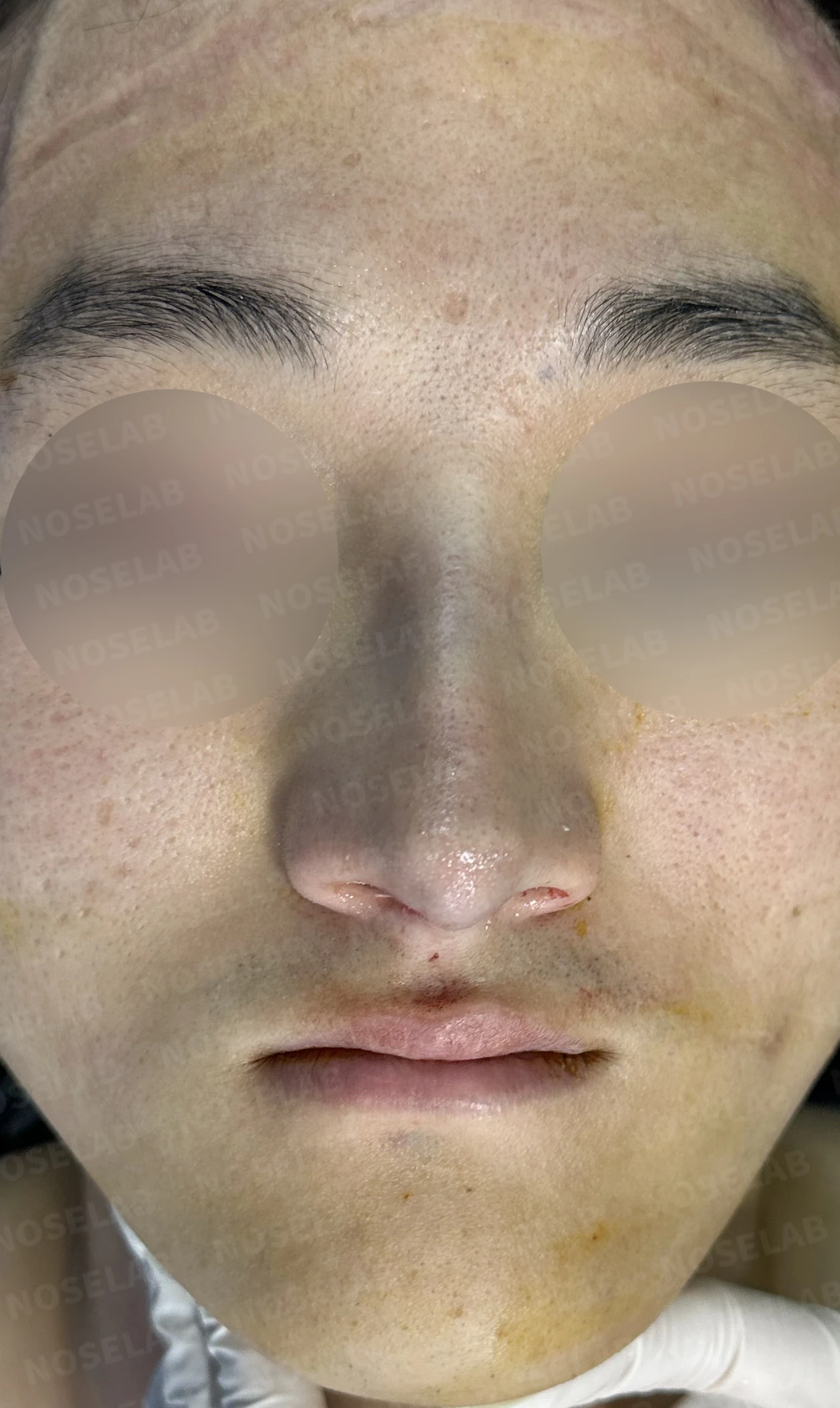 휜코 교정하면 안면 비대칭이 좋아질까요? — 수술 전 / 수술 직후 0일 직후 사진은 부기가 있는 상태로 최종 결과와 다를 수 있습니다.