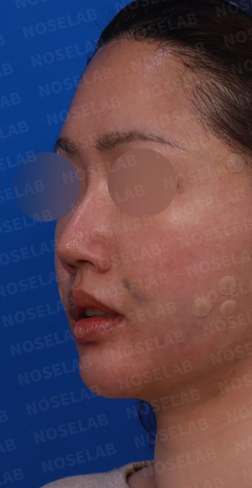 재수술한 코가 휘어 보이고 코끝이 처지는 이유 — 디자인 상담 정면, 좌측 측면, 비스듬한 측면 사진