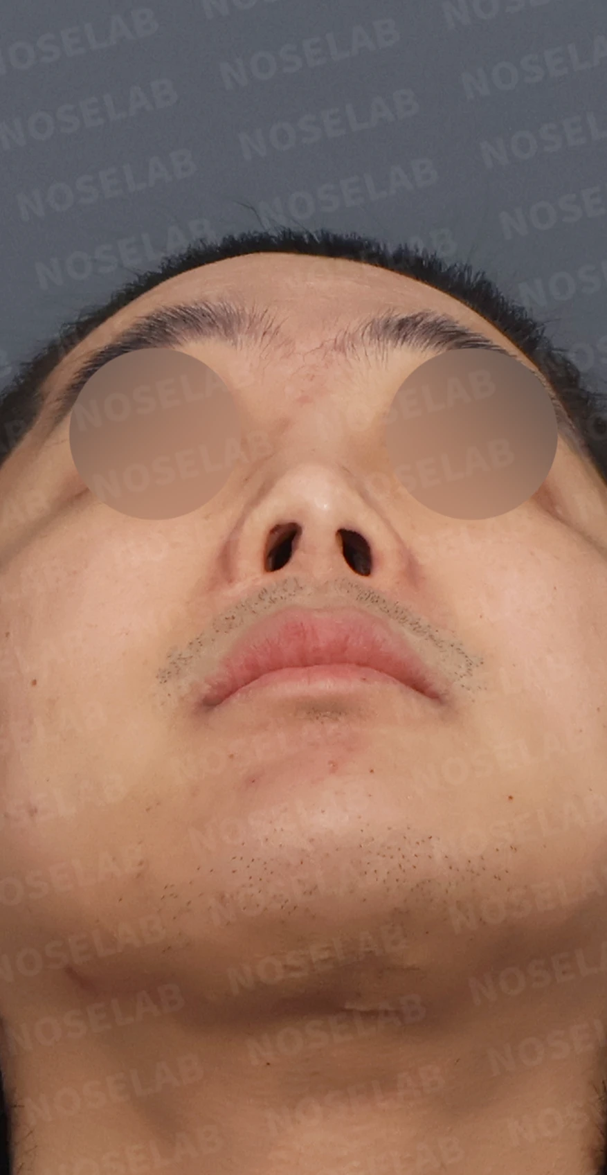 휜코 교정과 비공 비대칭, 자가늑연골로 바로잡은 코재수술 — 디자인 상담 우측 측면, 비스듬한 측면, 비공 사진입니다.