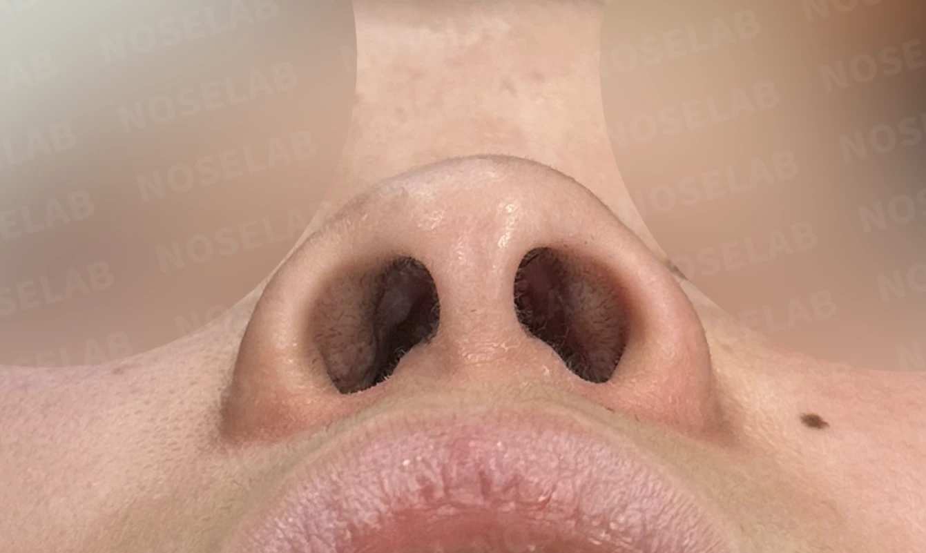낮고 퍼진 코, 기증늑연골과 실리콘 보형물로 자연스러운 코 라인 완성 — 전(좌) 직후(후)