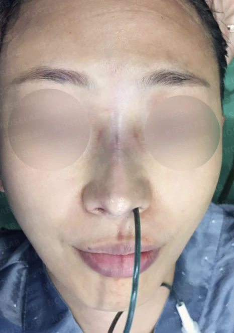 갈라져 보이는 코끝의 구조와 교정 방법 — 수술 전 / 수술 직후 0일 직후 사진은 부기가 있는 상태로 최종 결과와 다를 수 있습니다.