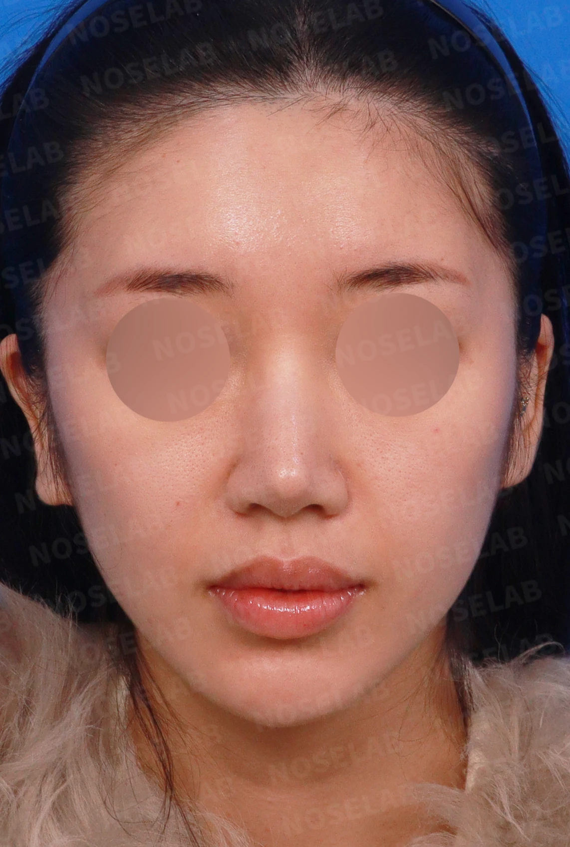 코끝 연골이 피부로 비쳐 보이는 이유와 진피 보강 방법 — 디자인 상담 정면, 좌측 측면, 비스듬한 측면 사진입니다.