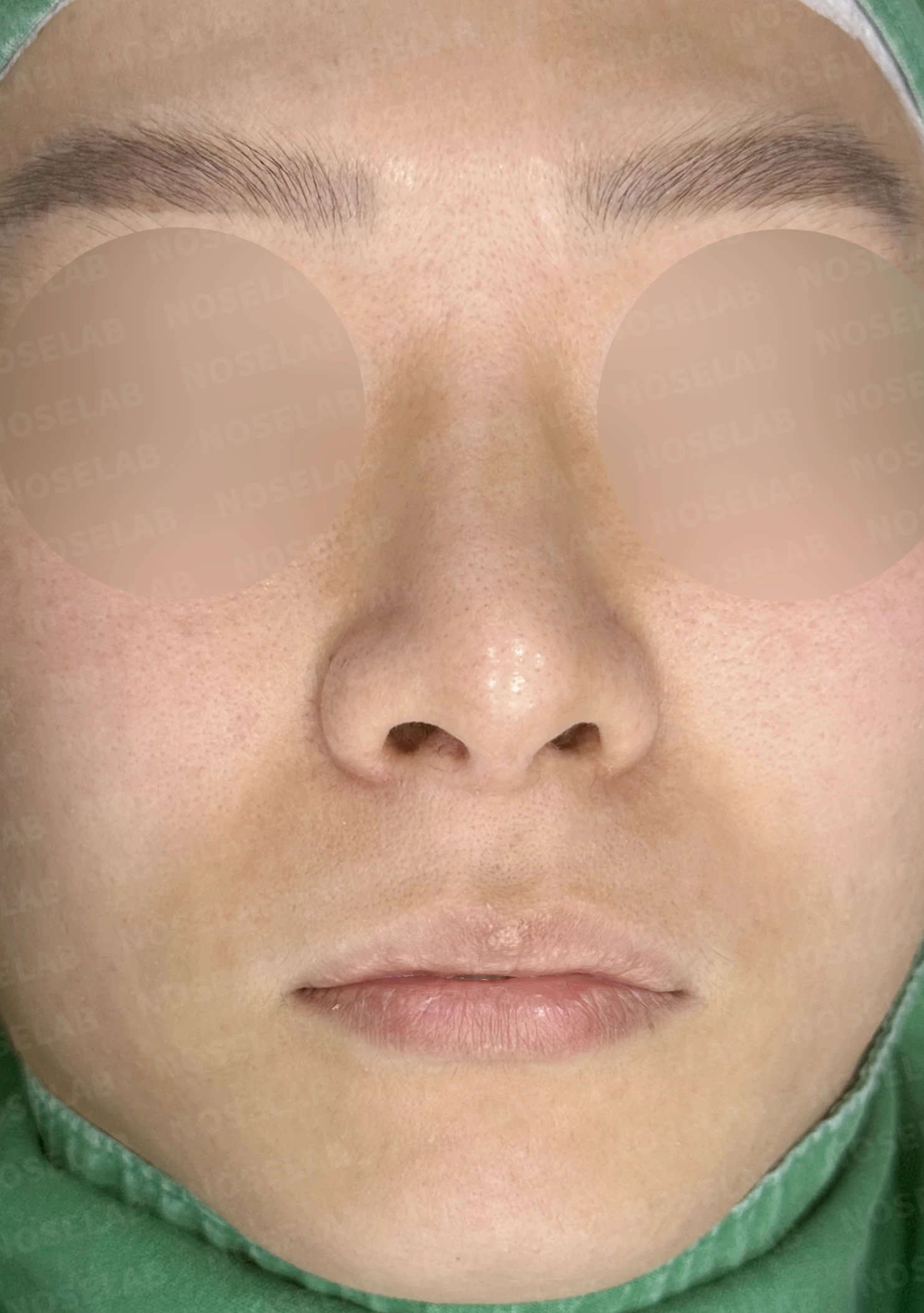 한쪽 비골이 함몰되면 왜 코가 휘어 보이는가, 절골 복원과 비중격 재건 — 수술 전 / 수술 직후 0일 직후 사진은 부기가 있는 상태로 최종 결과와 다를 수 있습니다.