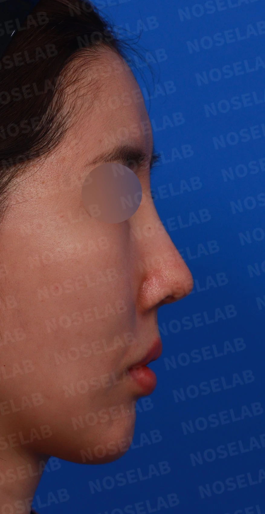 긴 코와 비대칭을 함께 교정하는 재수술 방법 — 디자인 상담 우측 측면, 비스듬한 측면, 비공 사진