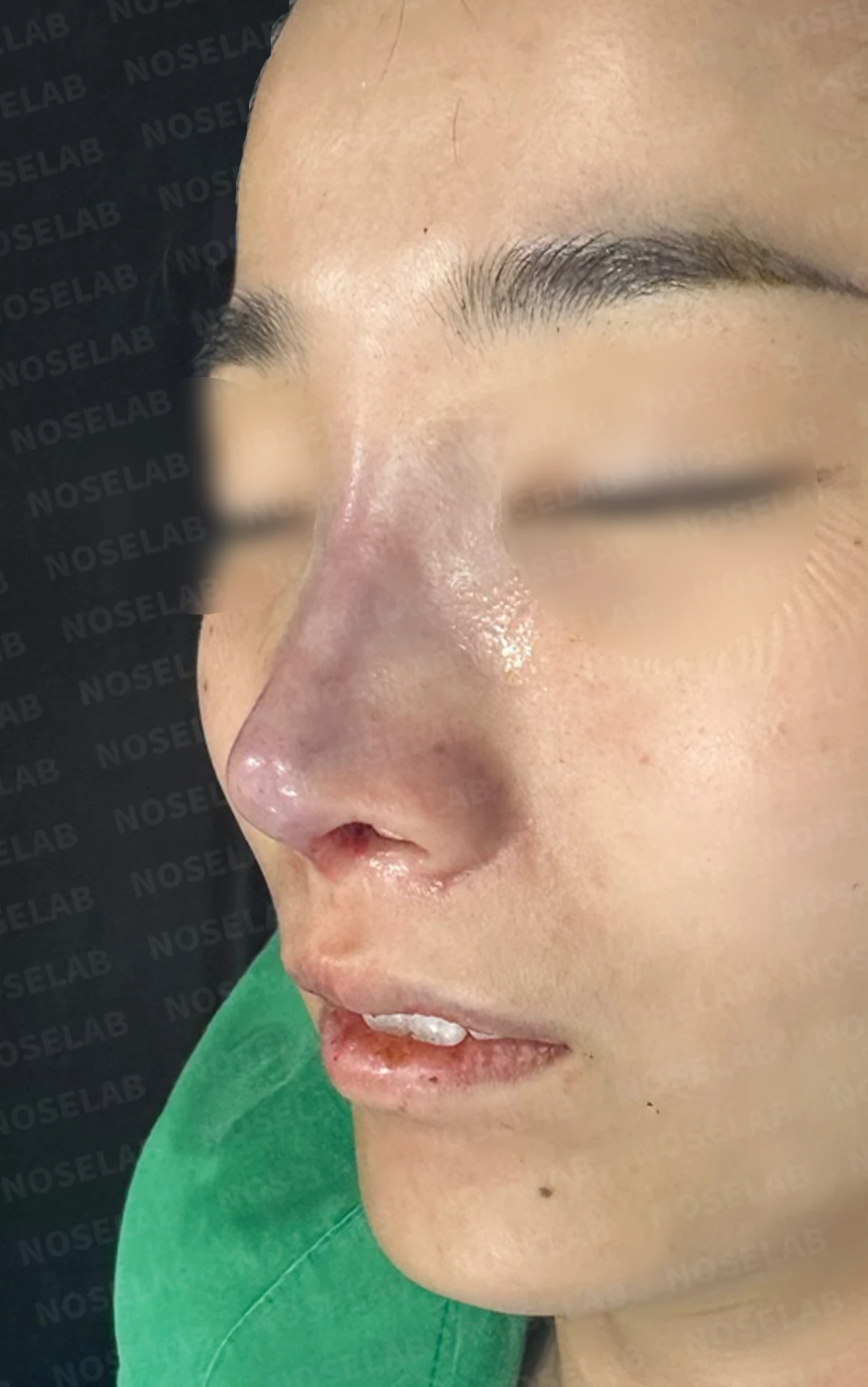 메드포어 점막 돌출로 인한 염증 코 - 자가늑연골 재건 수술 후기 — 본문 사진 25