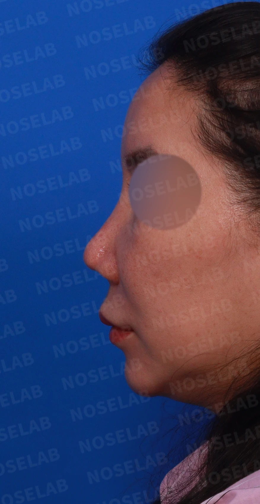 코끝이 찝히고 비주가 함몰되는 이유, 메드포어 제거와 재건은 어떻게 하나 — 디자인 상담 정면, 좌측 측면, 비스듬한 측면 사진