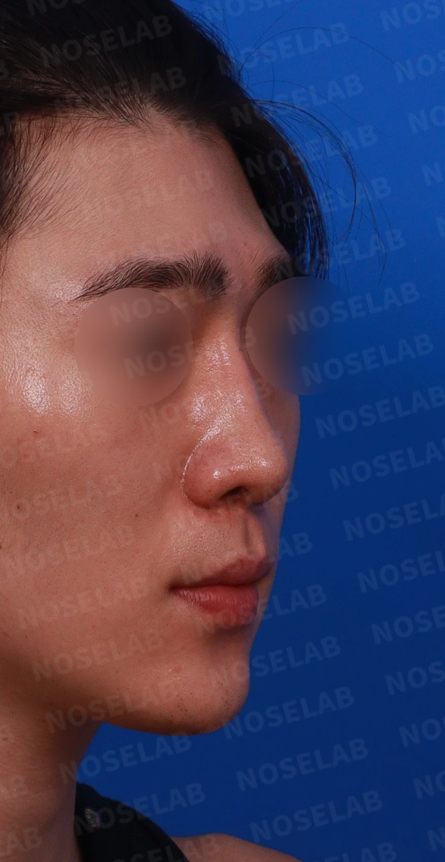 코골절과 반복 재수술 뒤 남는 흉터 조직과 비공 비대칭, 재건 방법 — 디자인 상담 우측 측면 , 비스듬한 측면 , 비공 사진입니다.