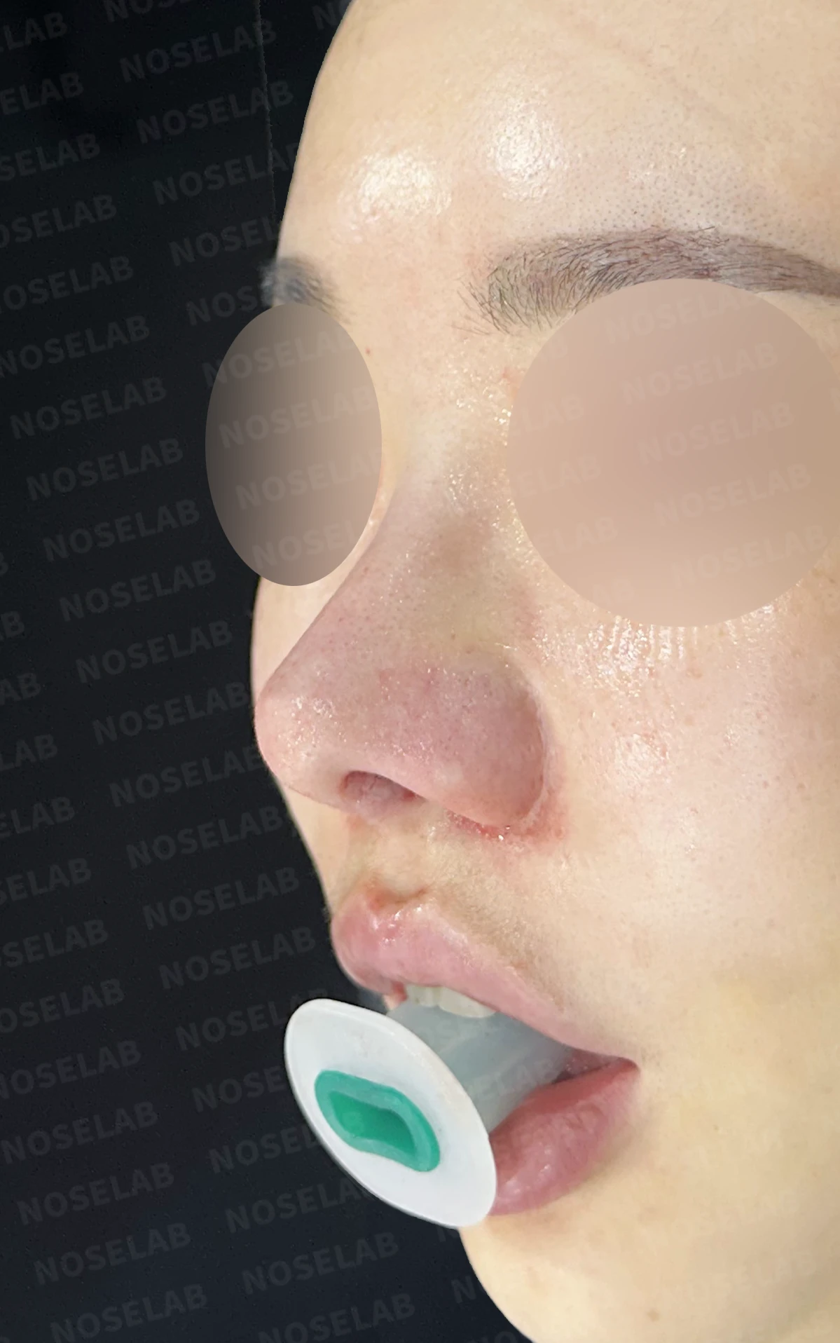 긴 코와 비공 비대칭, 자가늑연골로 자연스럽게 교정한 코재수술 — 직후 정면, 비스듬한 측면, 측면 사진