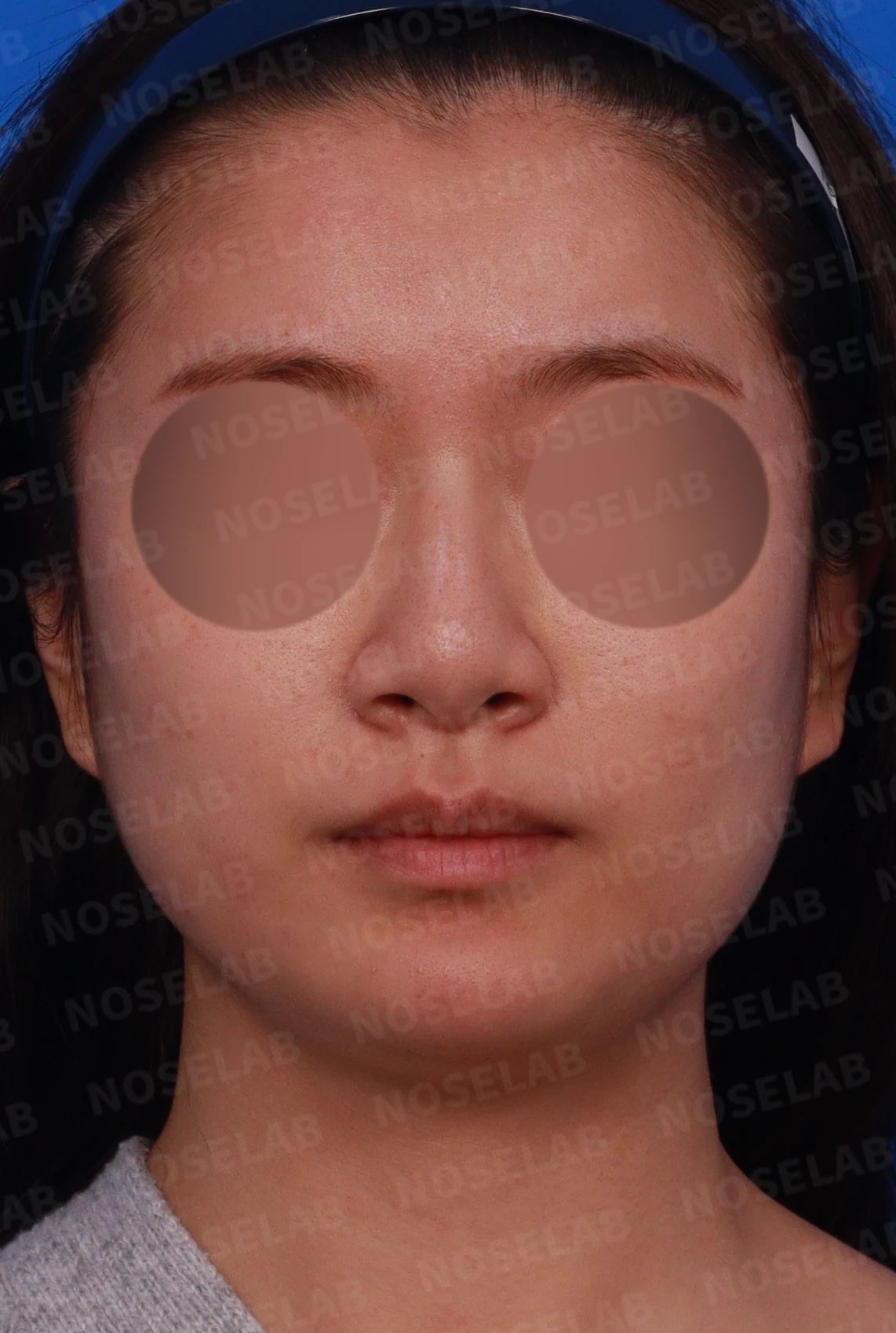 복코와 퍼진 코, 처진 코끝이 함께 오는 이유와 슬림한 라인을 만드는 방법 — 디자인 상담 정면, 좌측 측면, 비스듬한 측면 사진