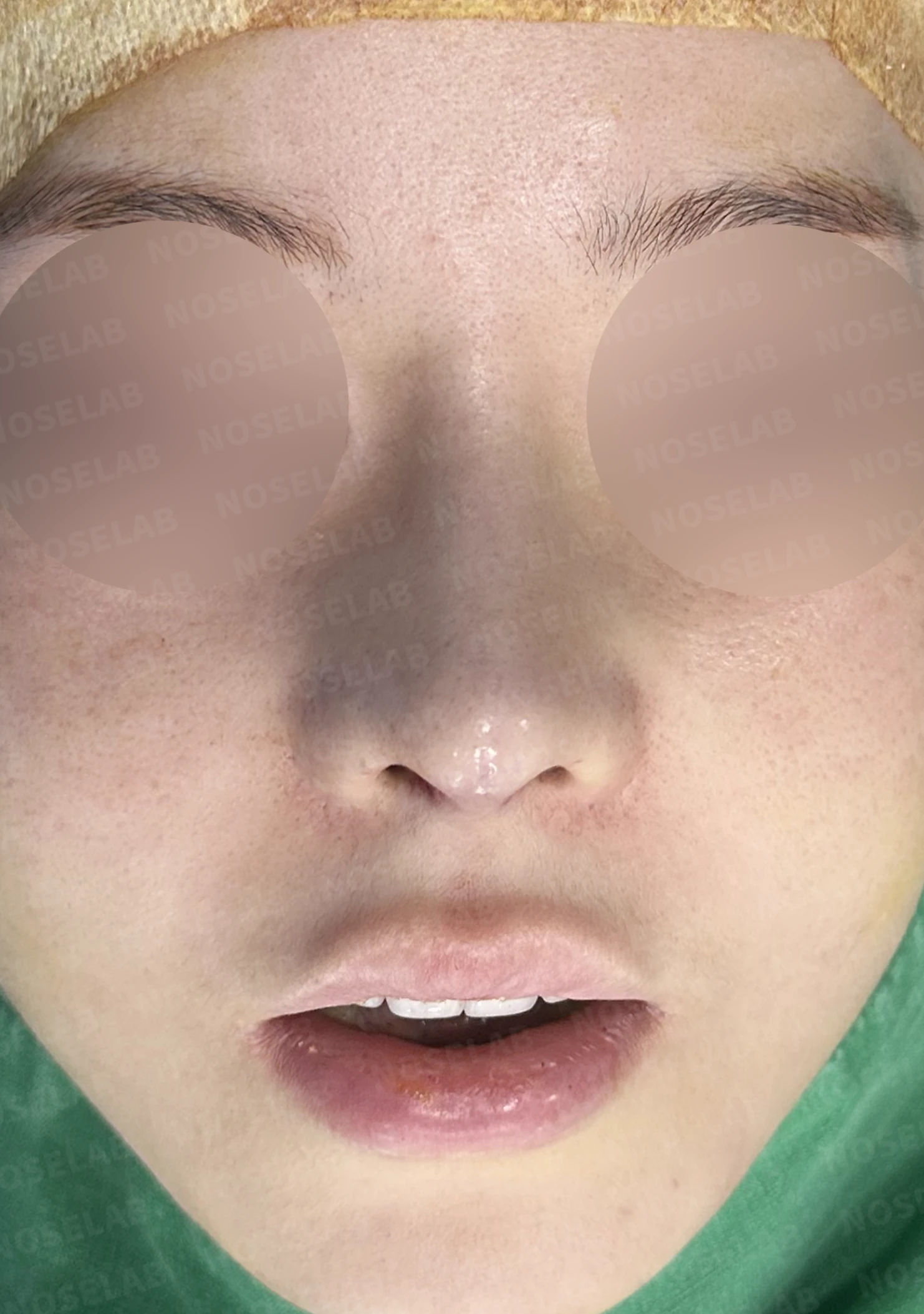양악 수술 뒤 코가 퍼지고 낮아지는 이유와 비중격 재건 — 수술 전 / 수술 직후 0일 직후 사진은 부기가 있는 상태로 최종 결과와 다를 수 있습니다.