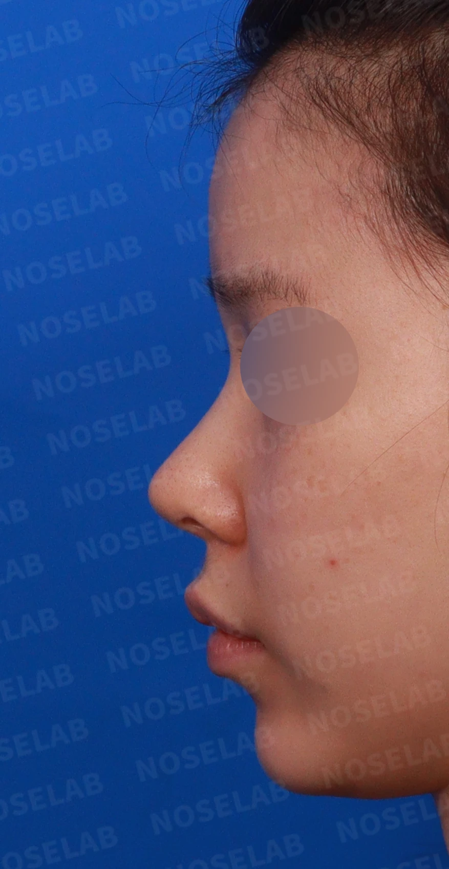 귀연골만으로 코끝을 받쳤을 때 생기는 변화와 늑연골 재건 방법 — 디자인 상담 정면, 비스듬한 측면, 좌측 측면 사진입니다.