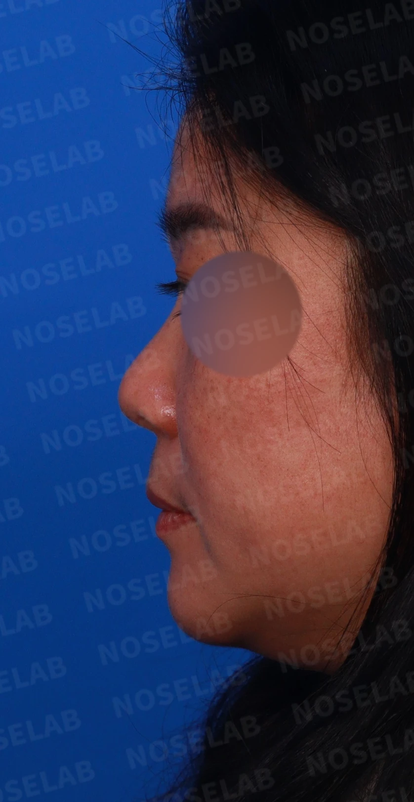 짧은 코와 코막힘을 함께 교정하는 방법 — 디자인 상담 정면, 좌측 측면, 비스듬한 측면 사진입니다.