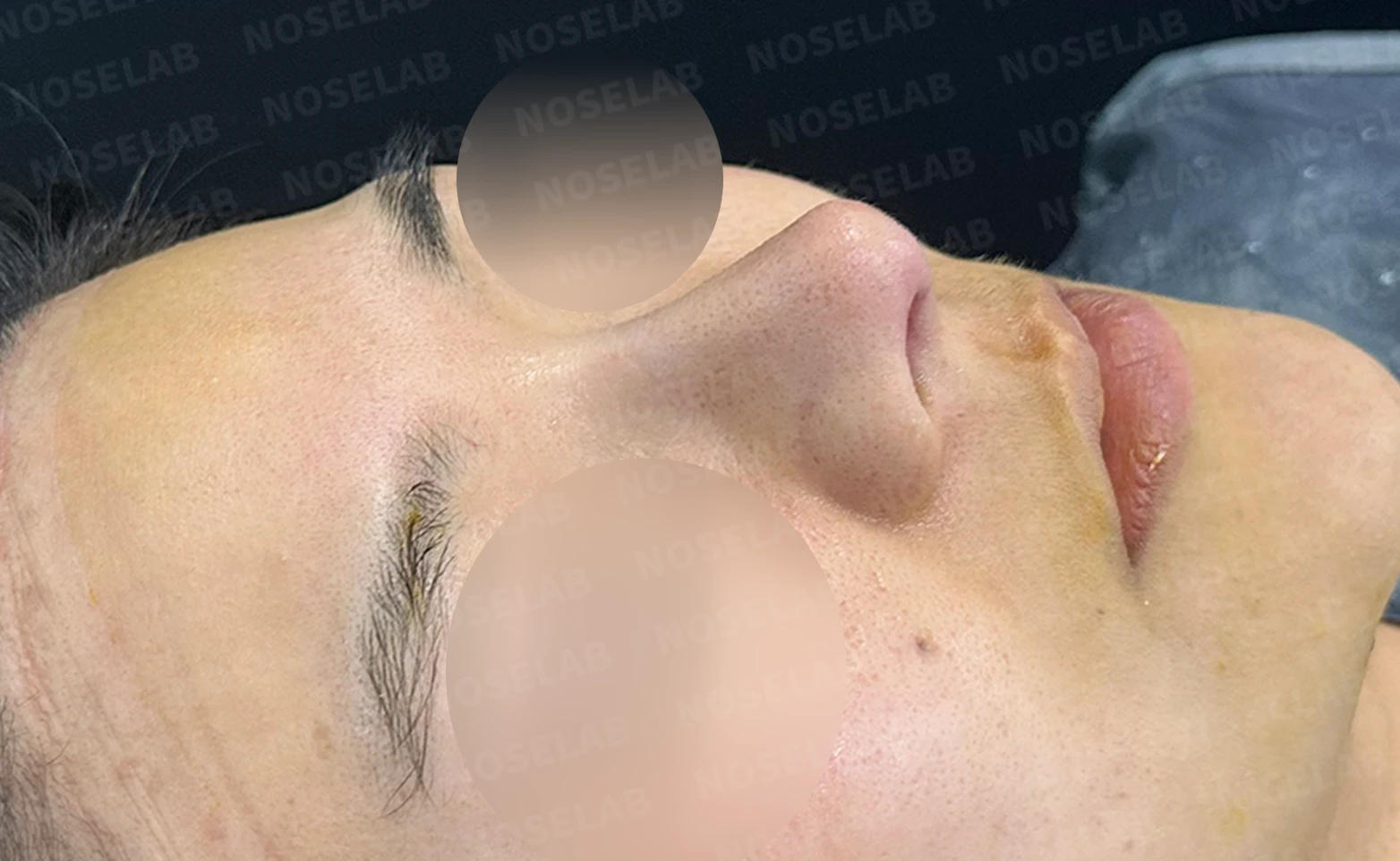복코 수술은 어떻게 하나요? — 수술 전 / 수술 직후 0일 직후 사진은 부기가 있는 상태로 최종 결과와 다를 수 있습니다.