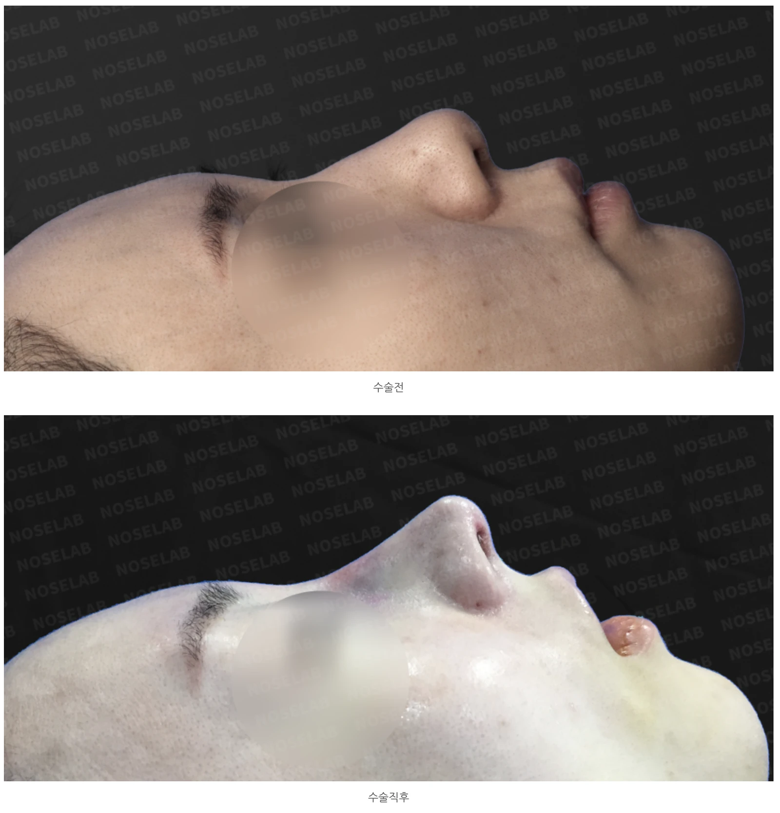 뭉툭한 복코의 구조와 교정 방법 — 본문 사진 18