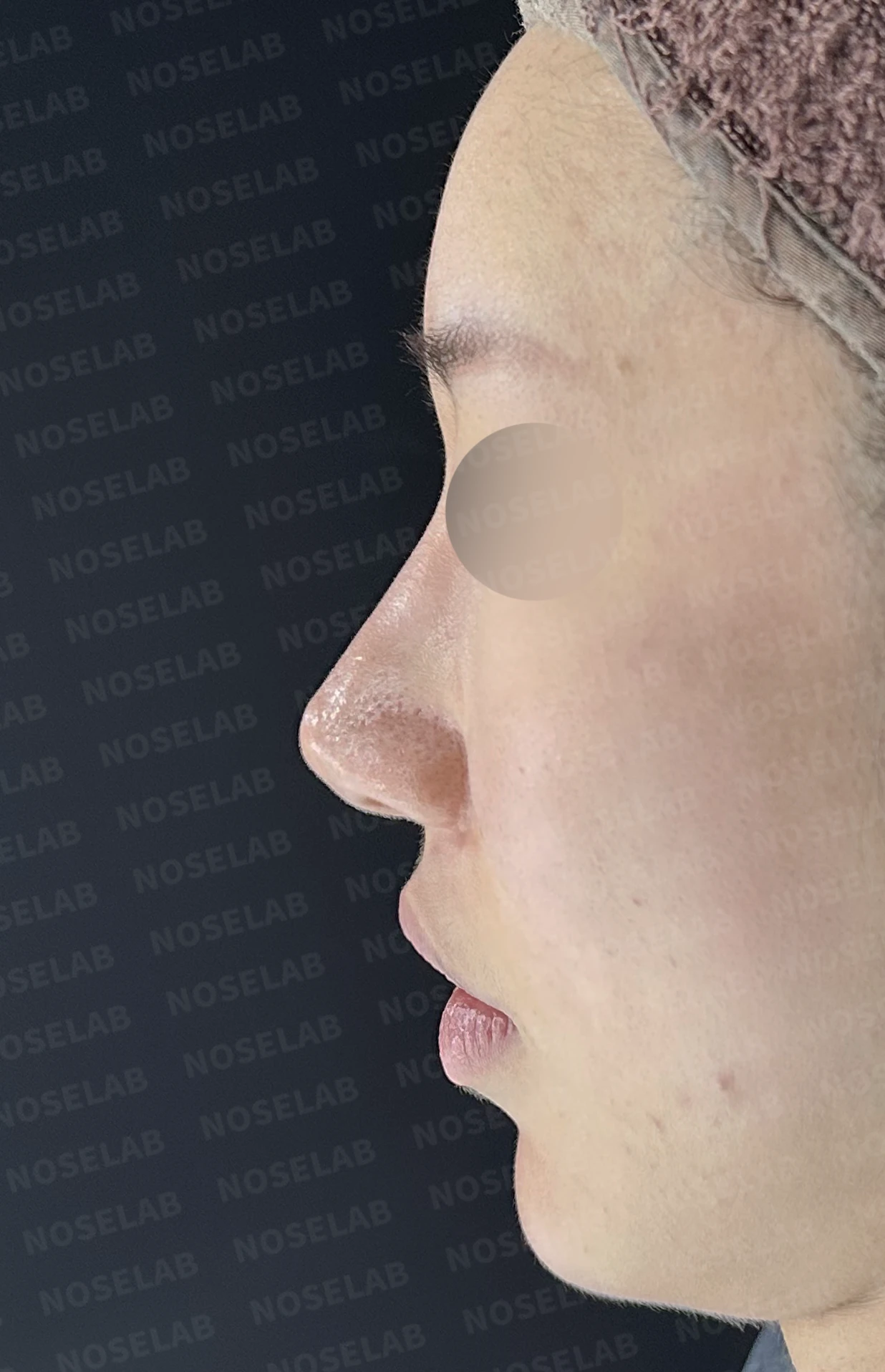 코끝 연골이 피부로 비쳐 보이는 이유와 진피 보강 방법 — 수술 전 / 수술 직후 0일 직후 사진은 부기가 있는 상태로 최종 결과와 다를 수 있습니다.