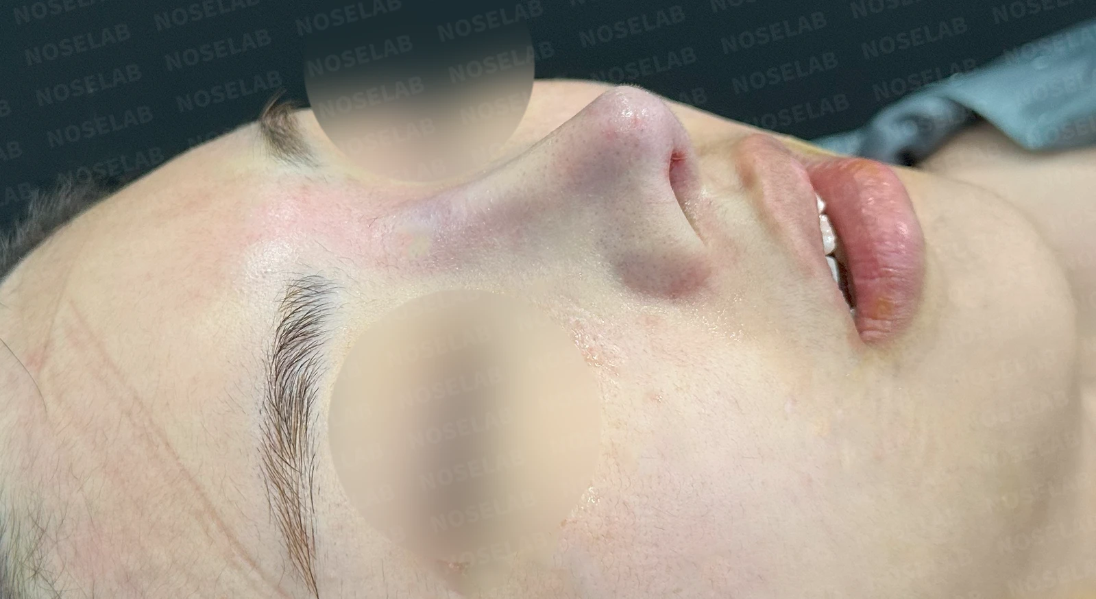 퍼진 코 개선과 콧구멍 비대칭 교정 방법 — 본문 사진 12