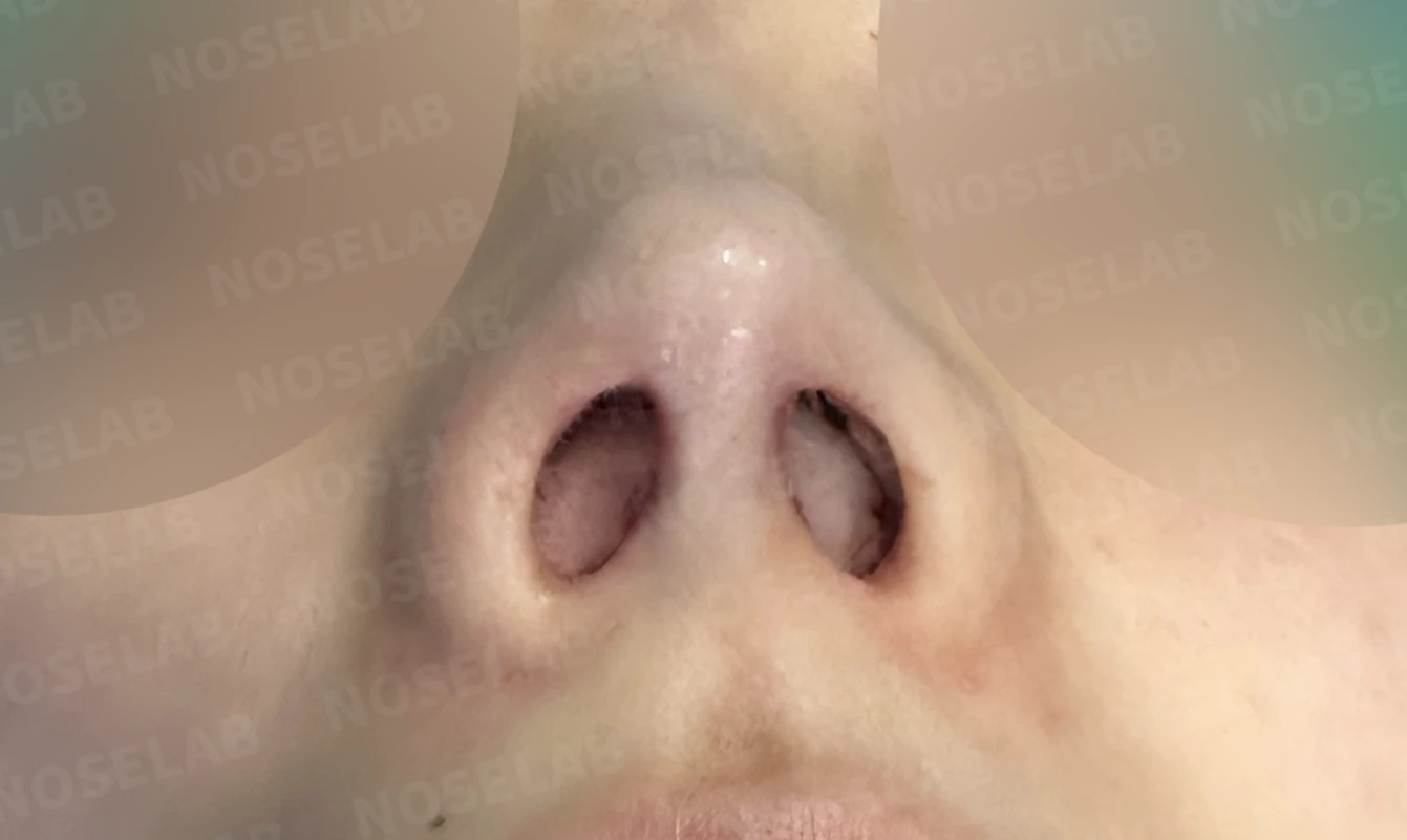 길고 처진 코끝과 코막힘, 자가늑연골로 자연스럽게 교정한 코재수술 — 전(좌) 직후(후)
