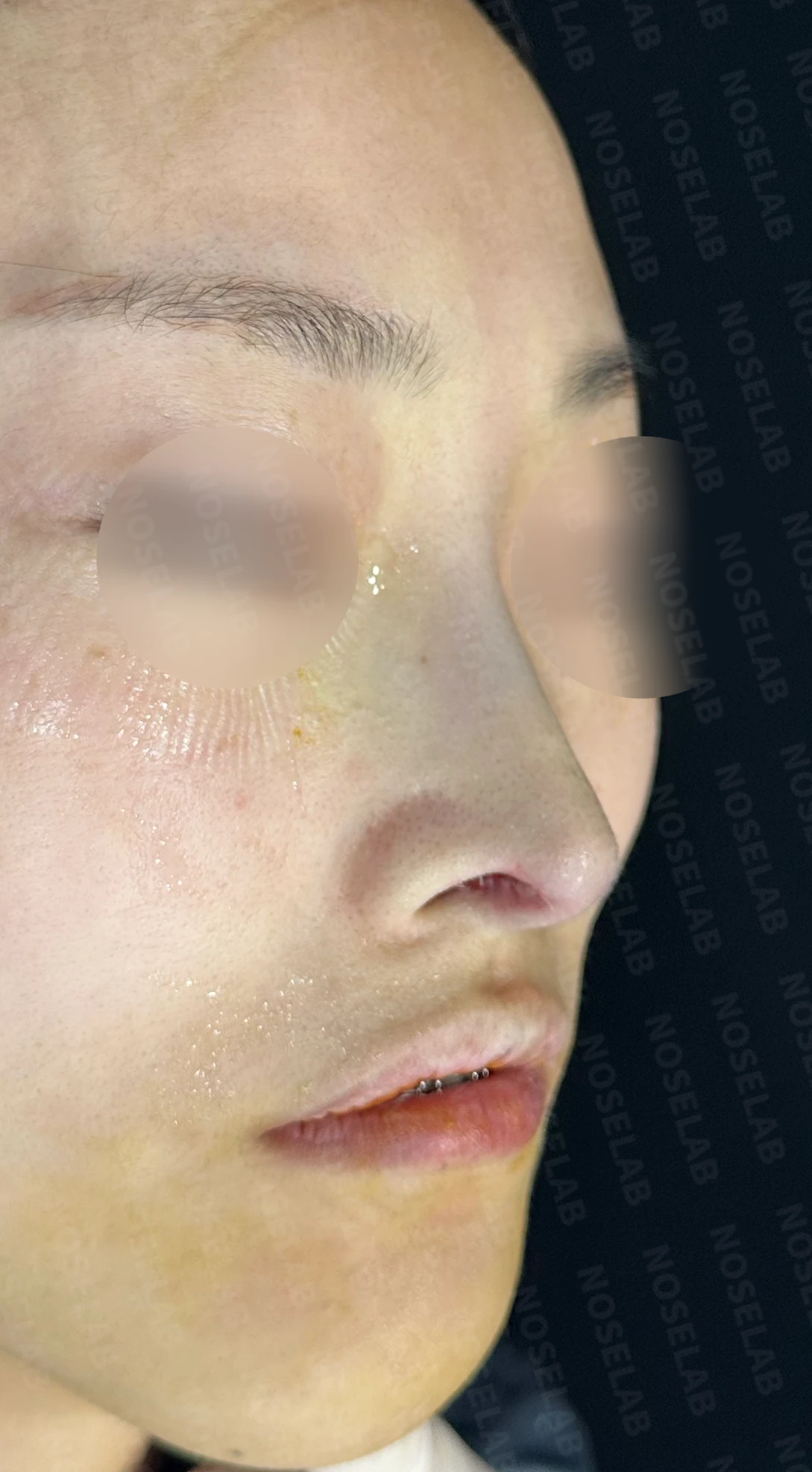 피부가 얇고 작은 들창코의 비대칭과 기능 교정 방법 — 수술 직후 0일 측면, 비스듬한 측면, 정면 사진 직후 사진은 부기가 있는 상태로 최종 결과와 다를 수 있습니다.