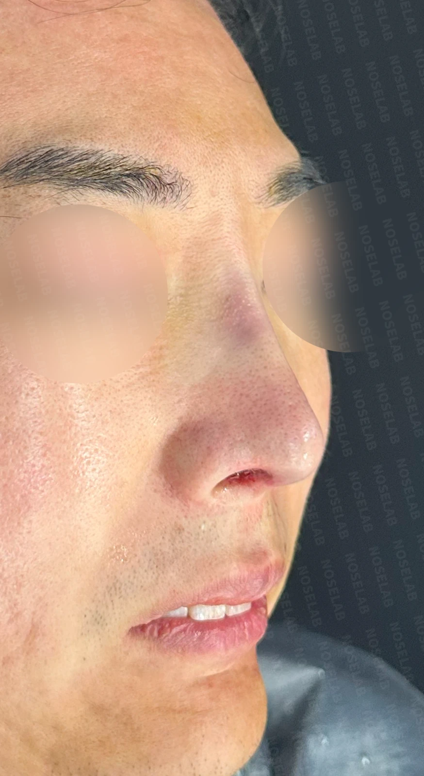 매부리코 수술 후 비대칭의 재수술 방법 — 수술 직후 0일 정면, 비스듬한 측면, 측면 사진 직후 사진은 부기가 있는 상태로 최종 결과와 다를 수 있습니다.