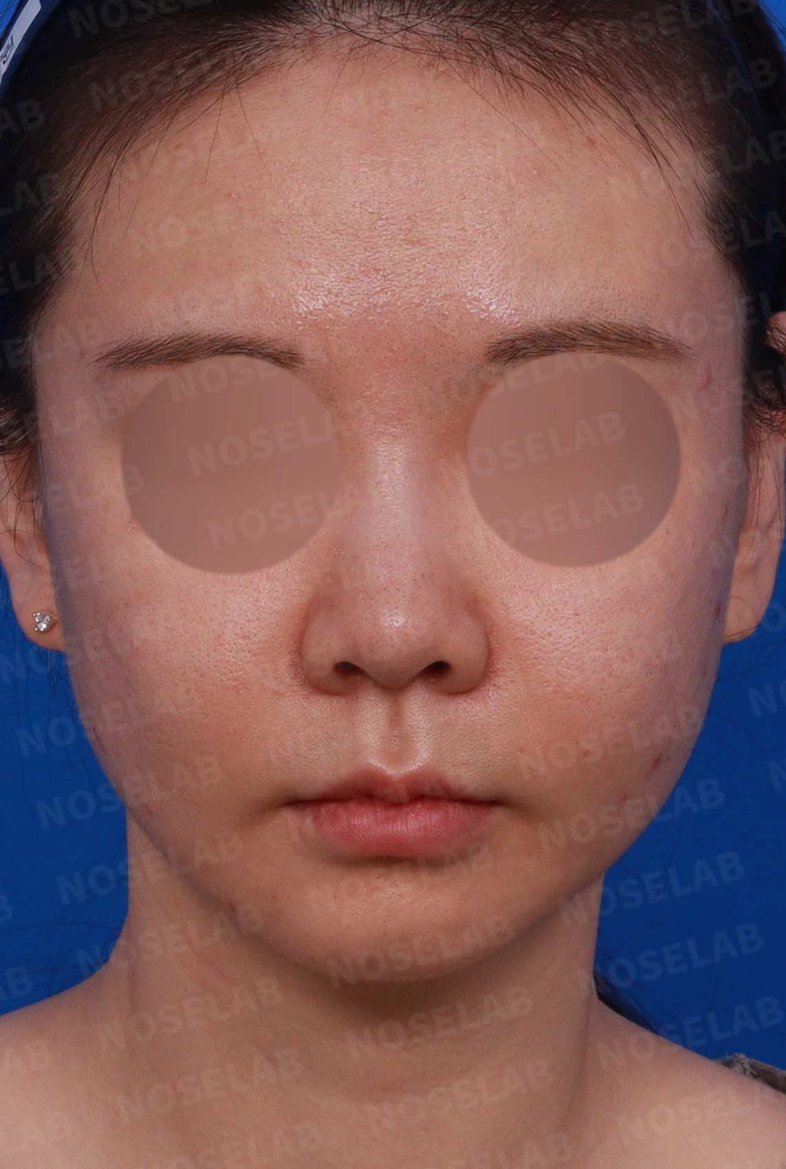 필러와 실 시술 뒤 코가 뭉툭해지는 이유, 이물질 제거와 코끝 교정 방법 — 디자인 상담 정면, 좌측 측면, 비스듬한 측면 사진