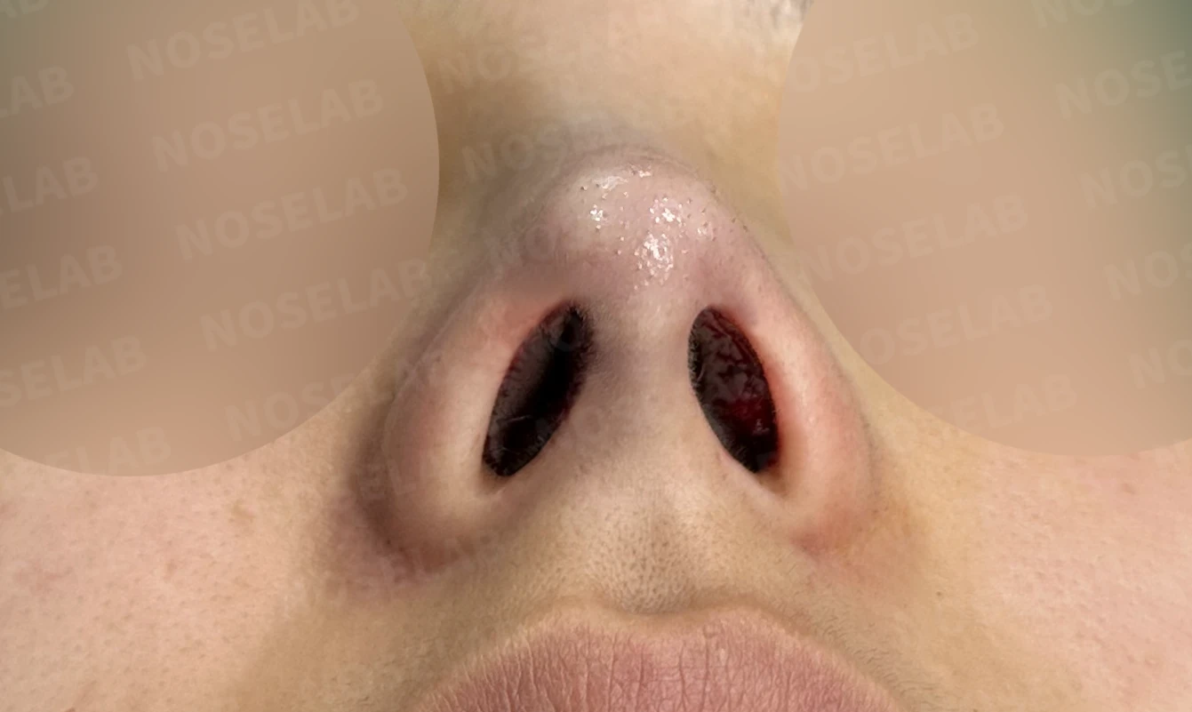 휘어진 매부리와 처진 코끝이 생기는 이유, 비중격 연장술은 어떻게 하나 — 수술 직후 0일 비공 사진입니다. 직후 사진은 부기가 있는 상태로 최종 결과와 다를 수 있습니다.