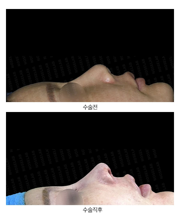 구축으로 들리고 휜 코의 자가늑연골 재건 방법 — 전후 비교
